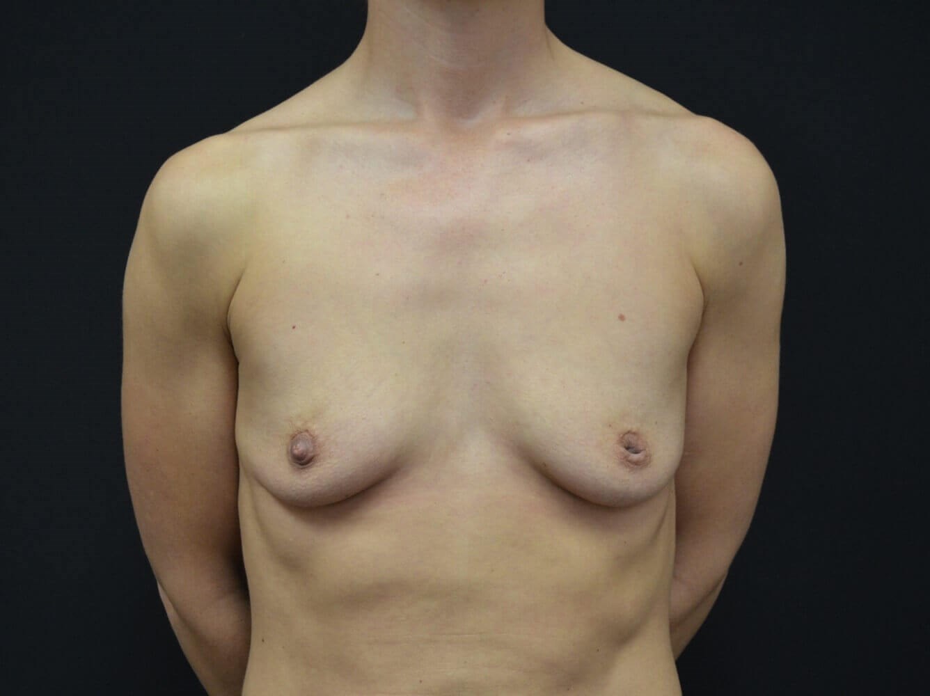 Breast Augmentation Before