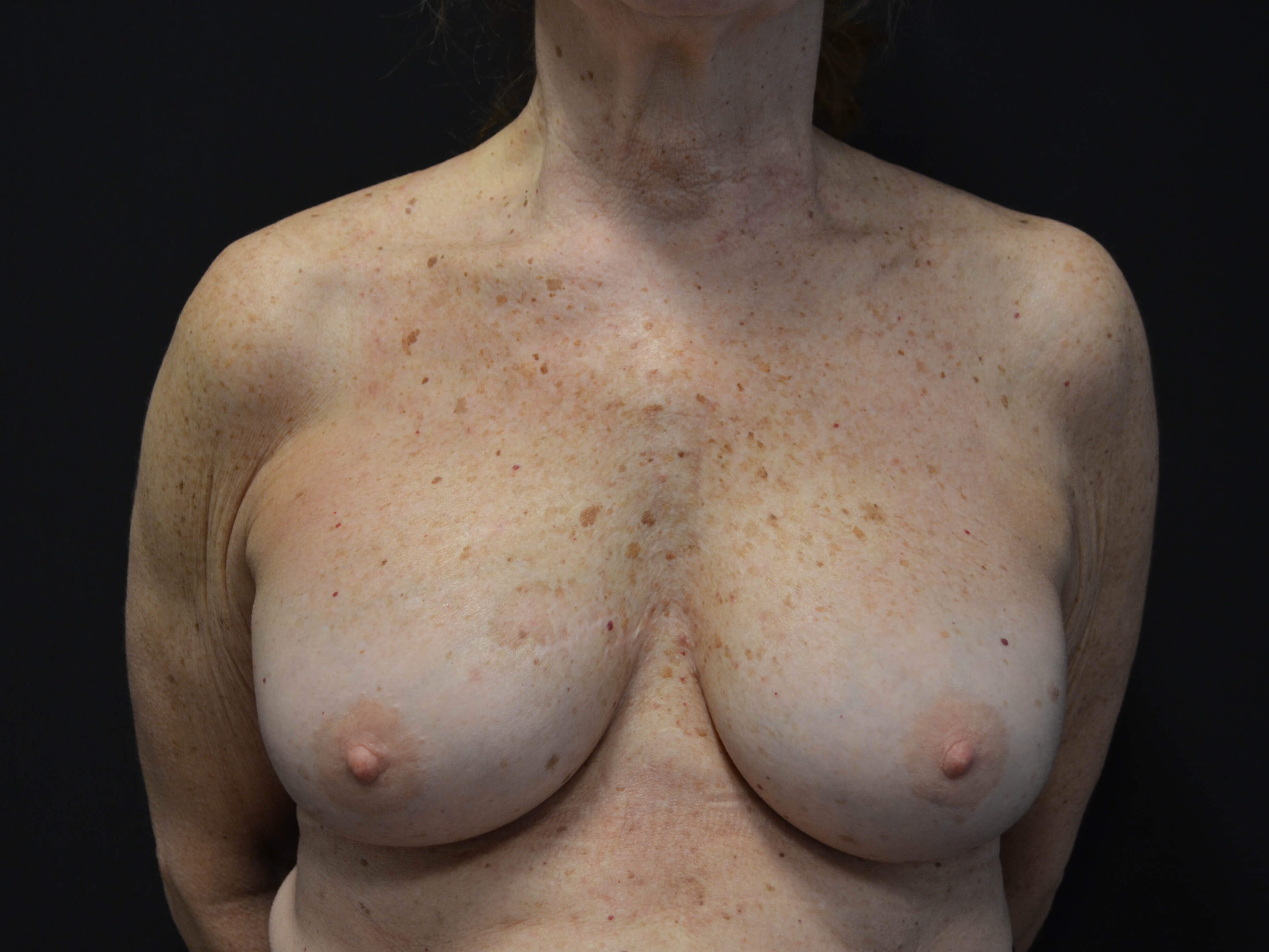 Breast Augmentation Revision After