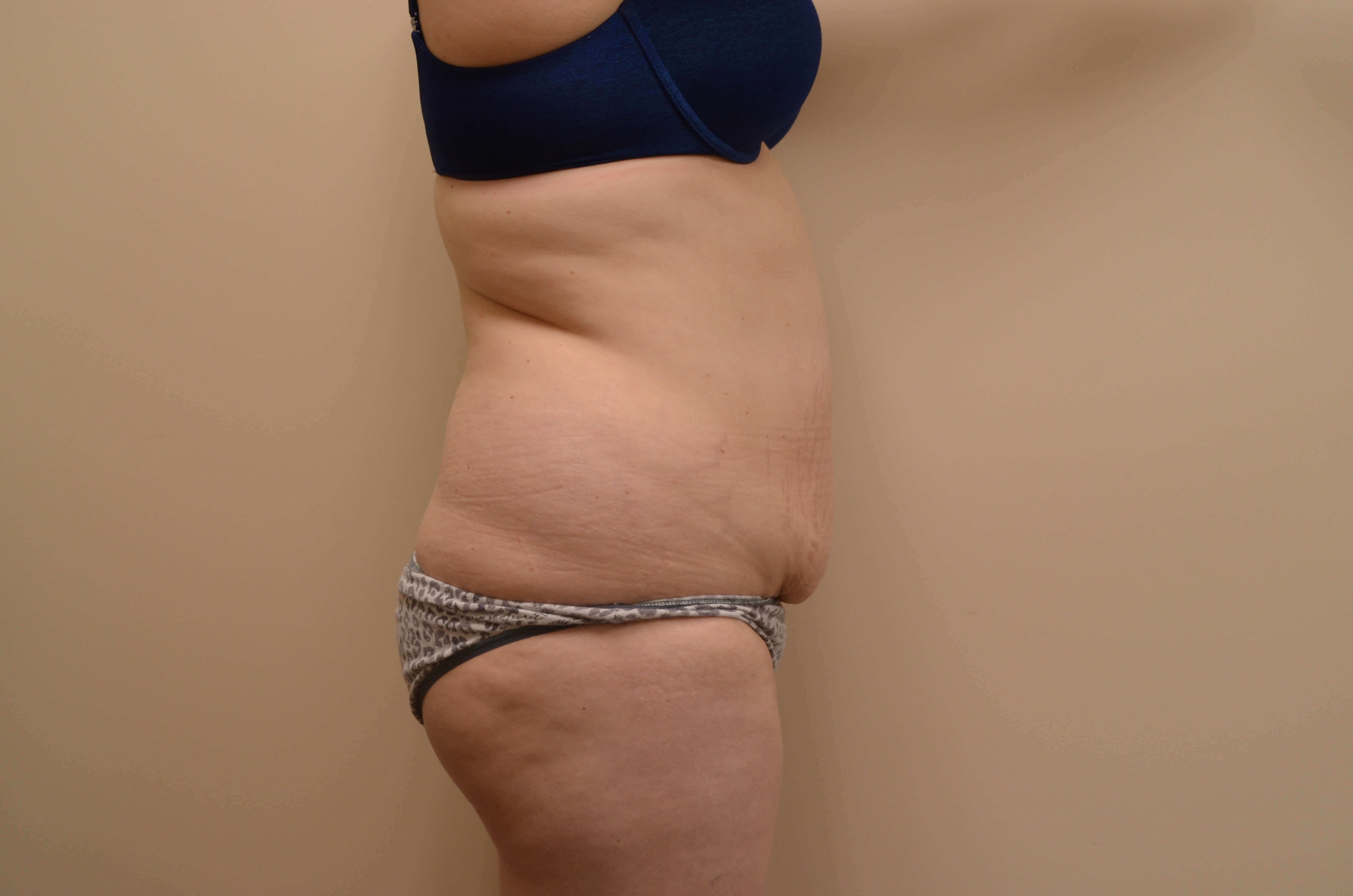 Tummy Tuck & Liposuction Before