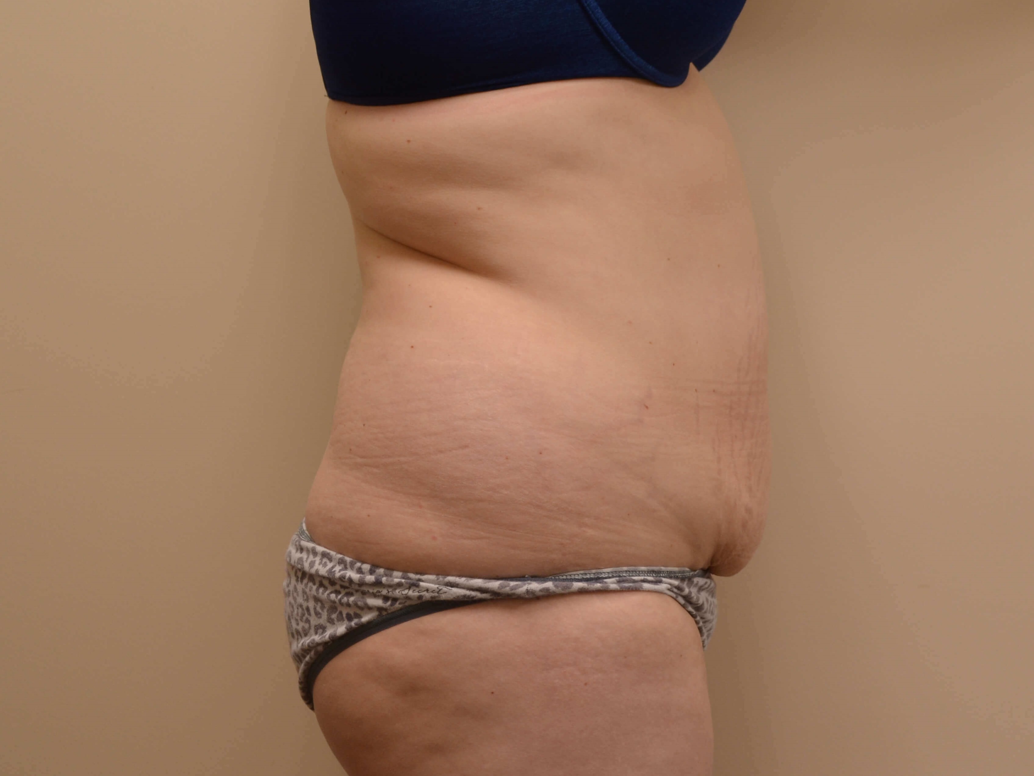 Tummy Tuck & Liposuction Before