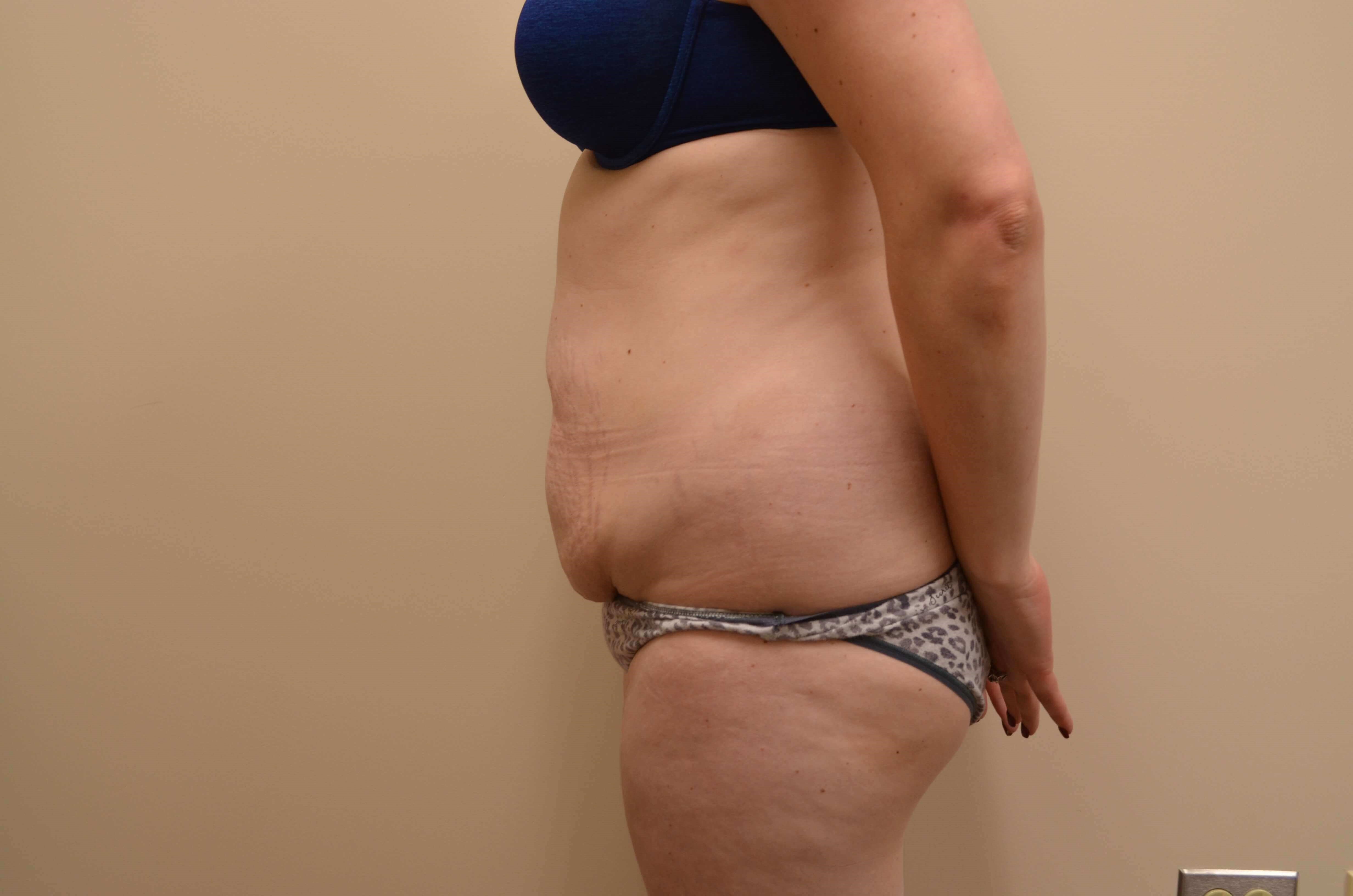 Tummy Tuck & Liposuction Before
