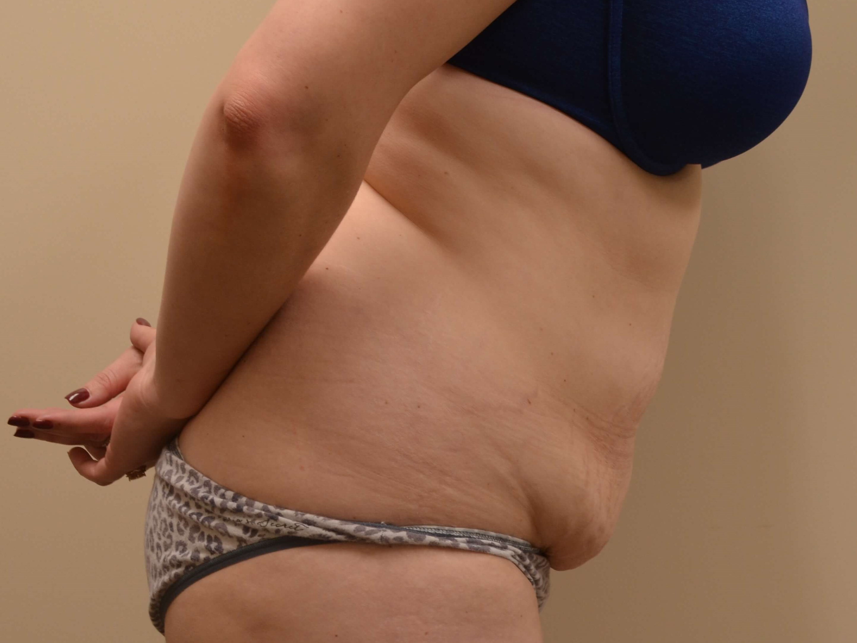 Tummy Tuck & Liposuction Before