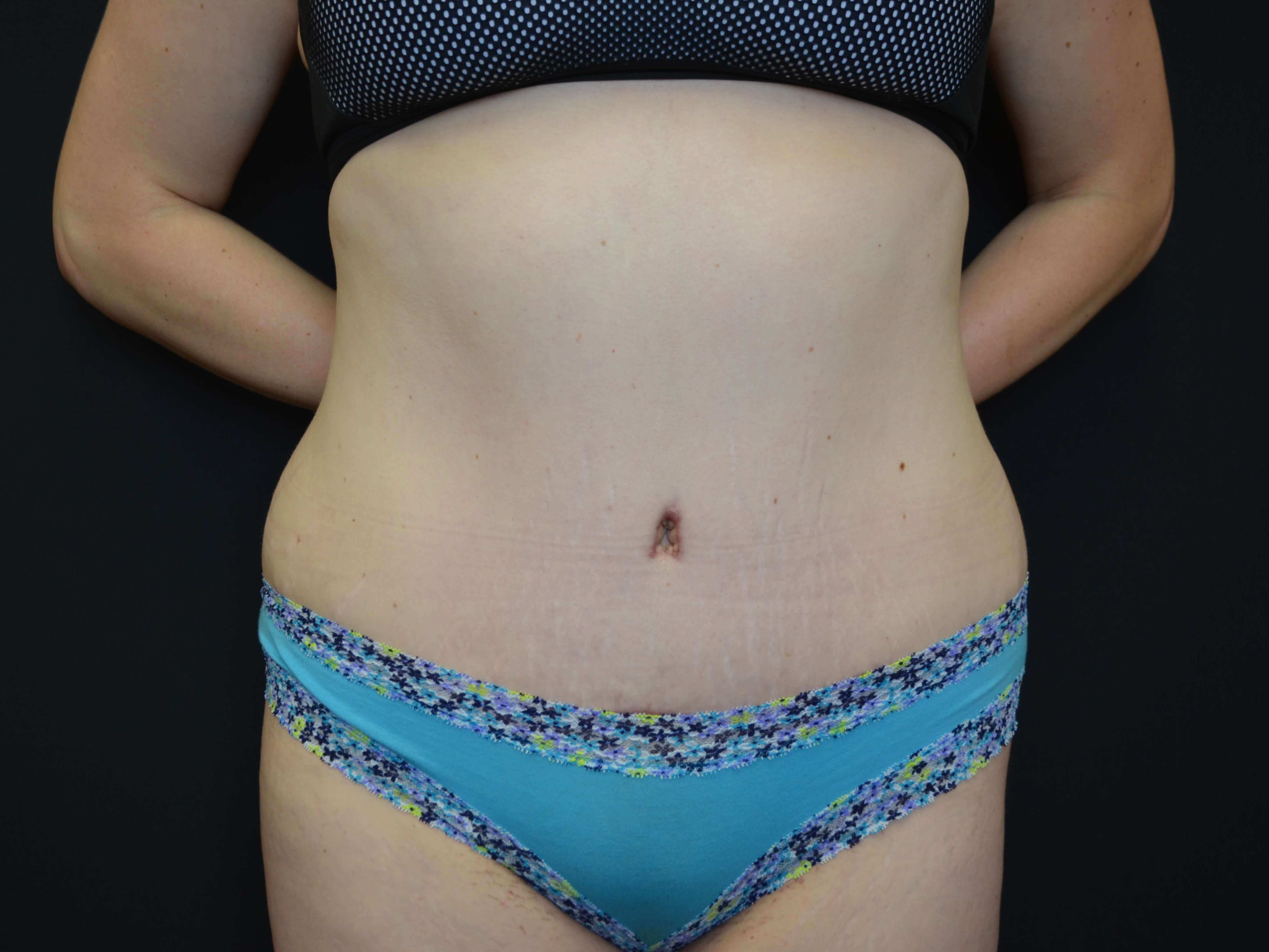 Tummy Tuck & Liposuction After