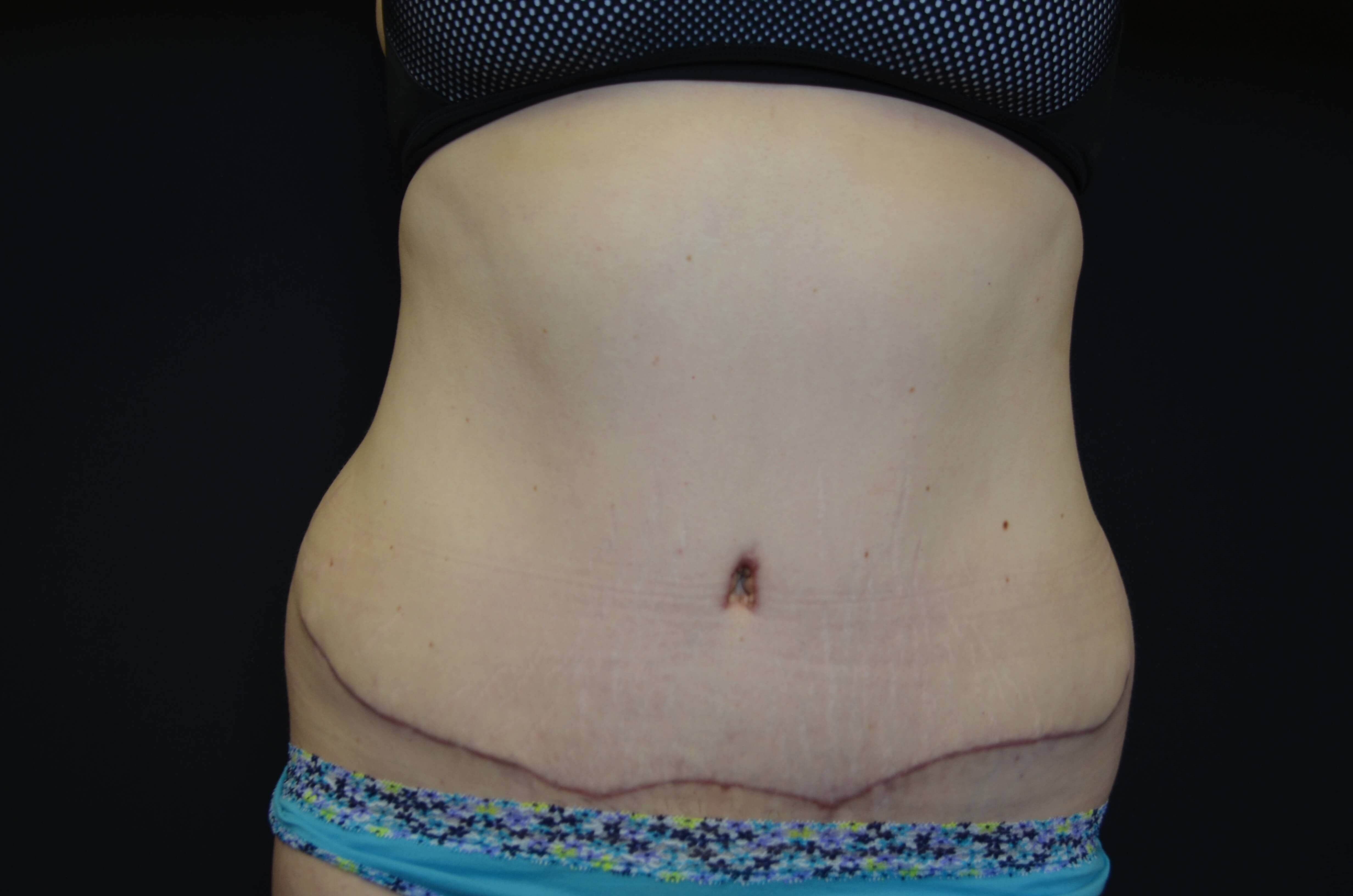 Tummy Tuck & Liposuction After