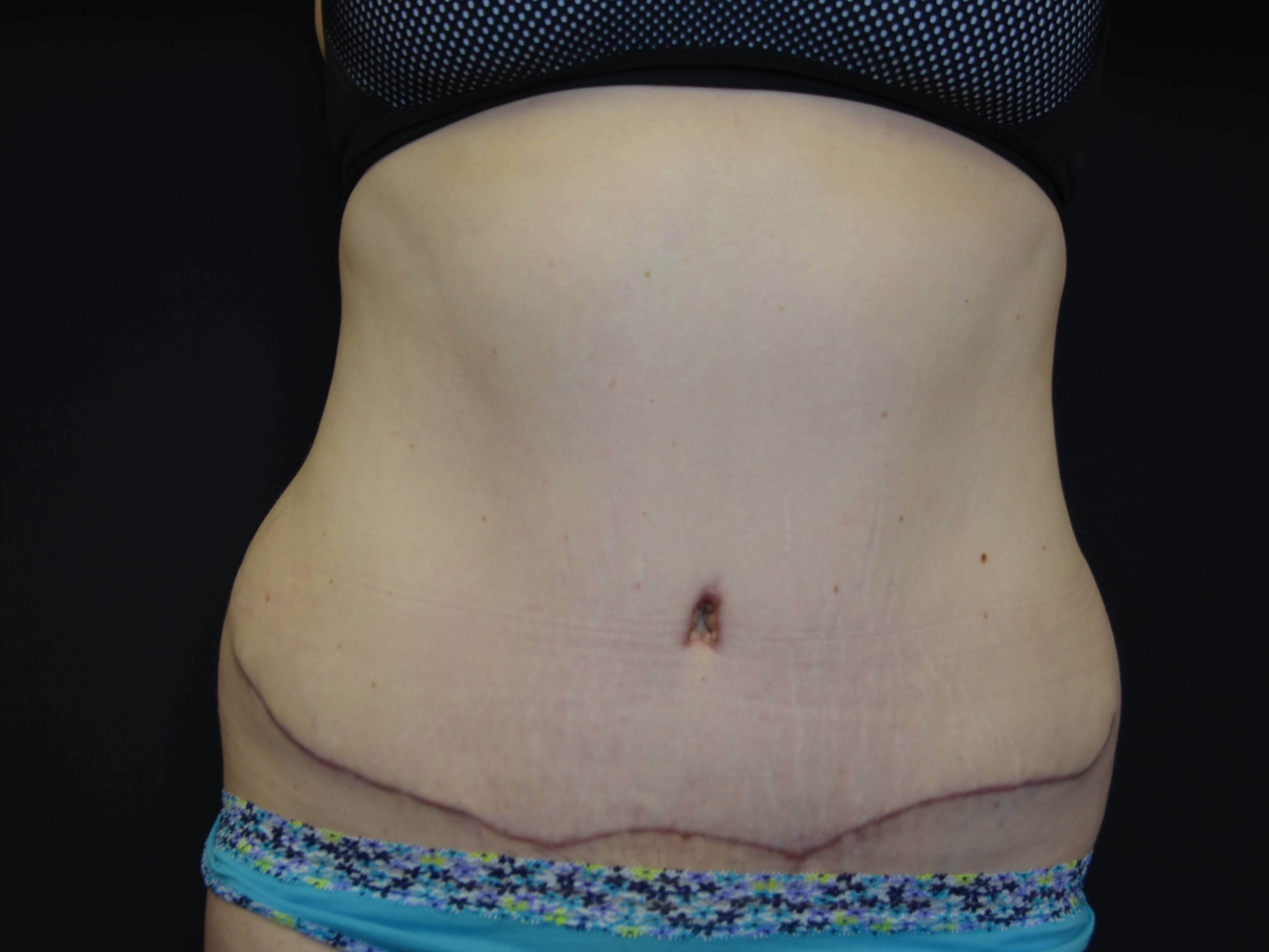 Tummy Tuck & Liposuction After