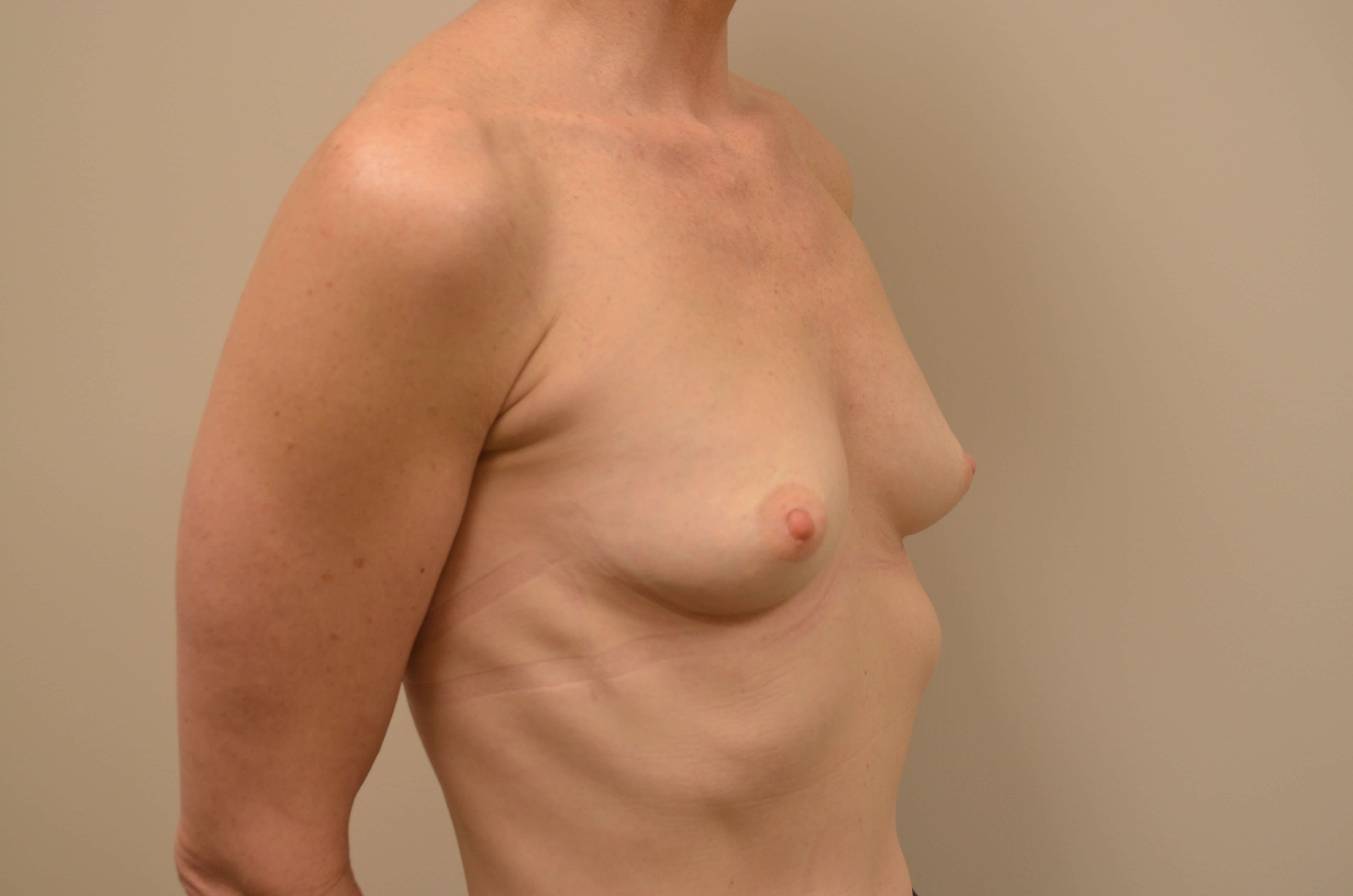 Breast Augmentation Before