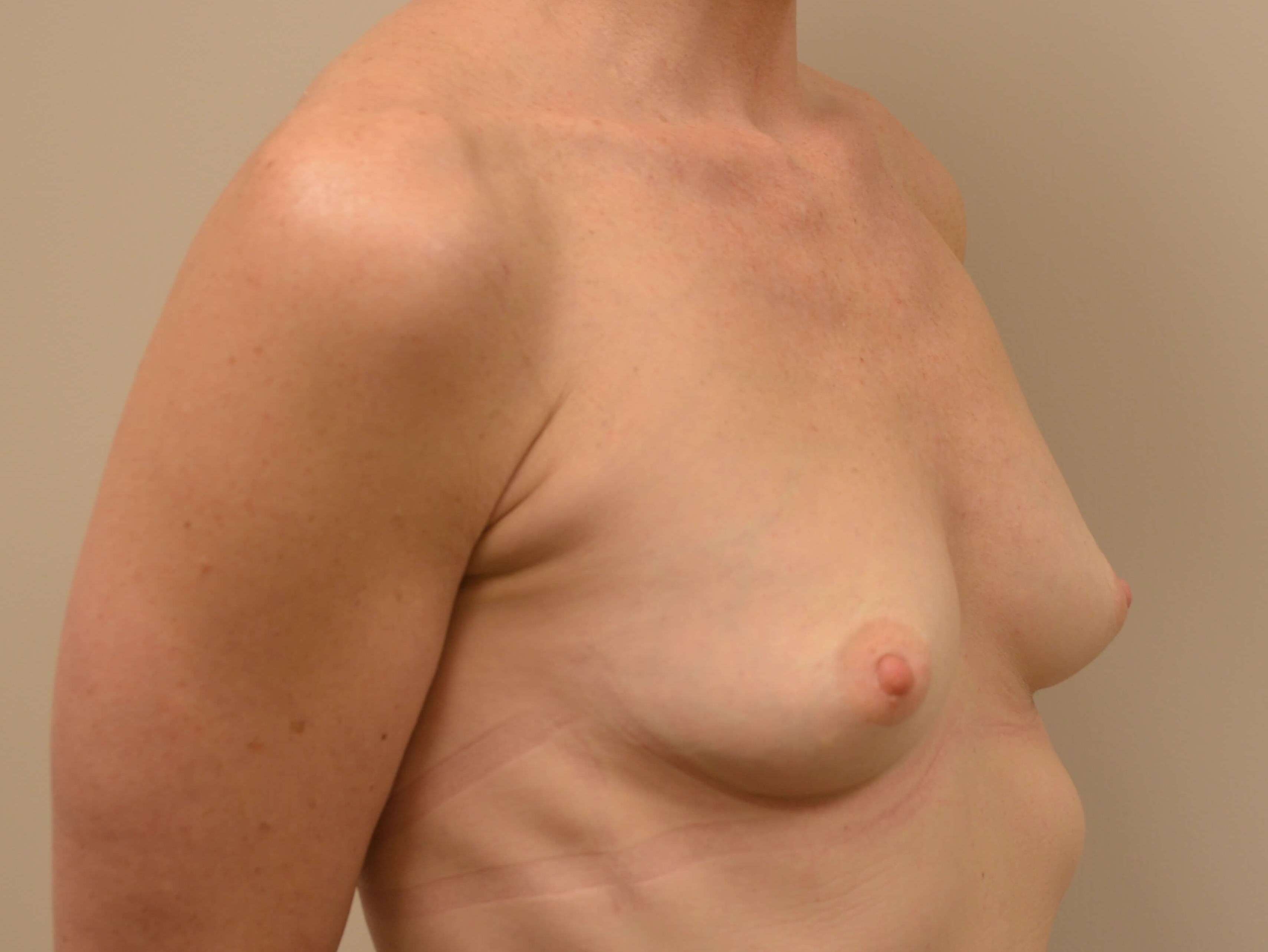 Breast Augmentation Before