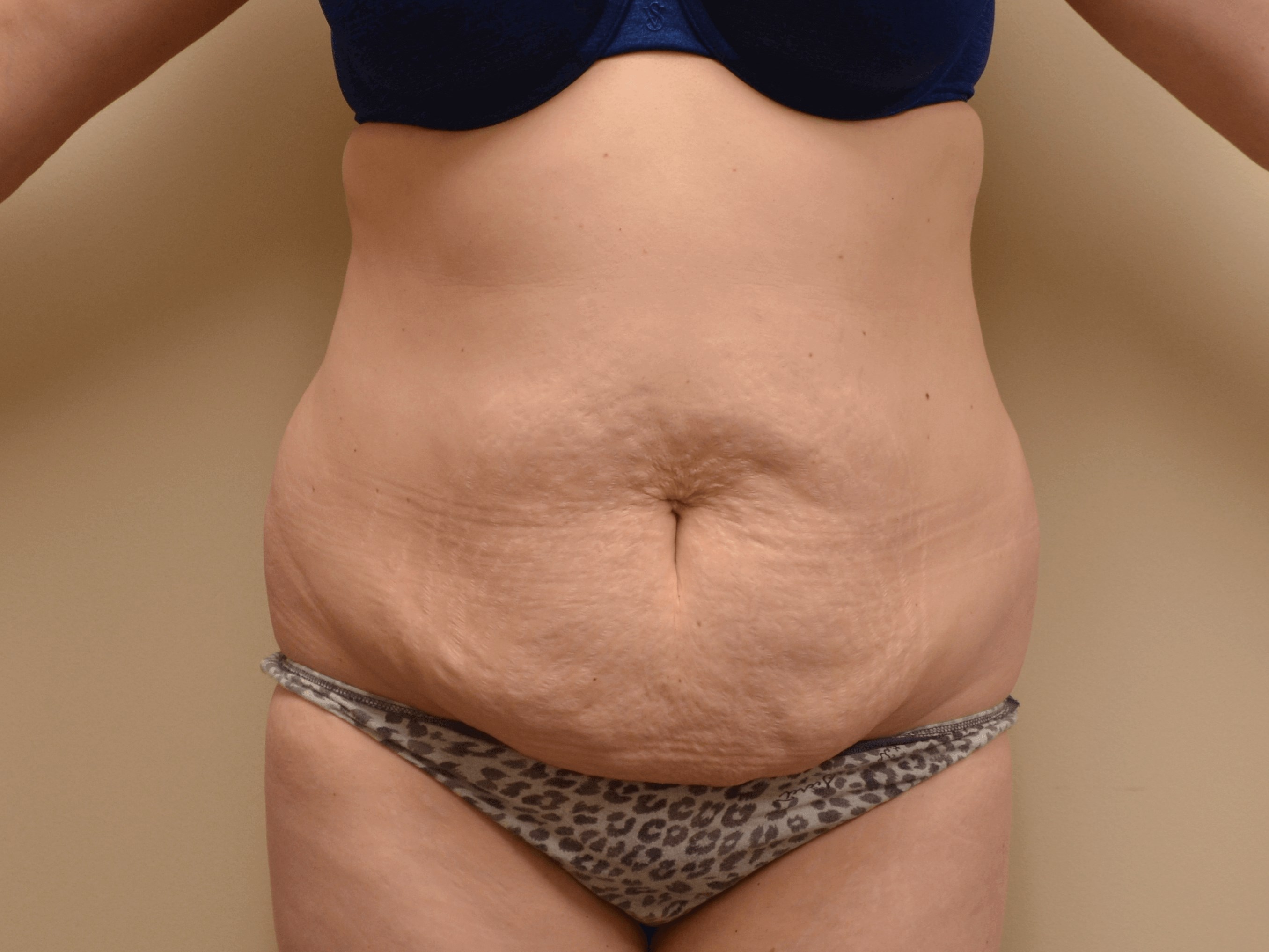 Tummy Tuck & Liposuction Before
