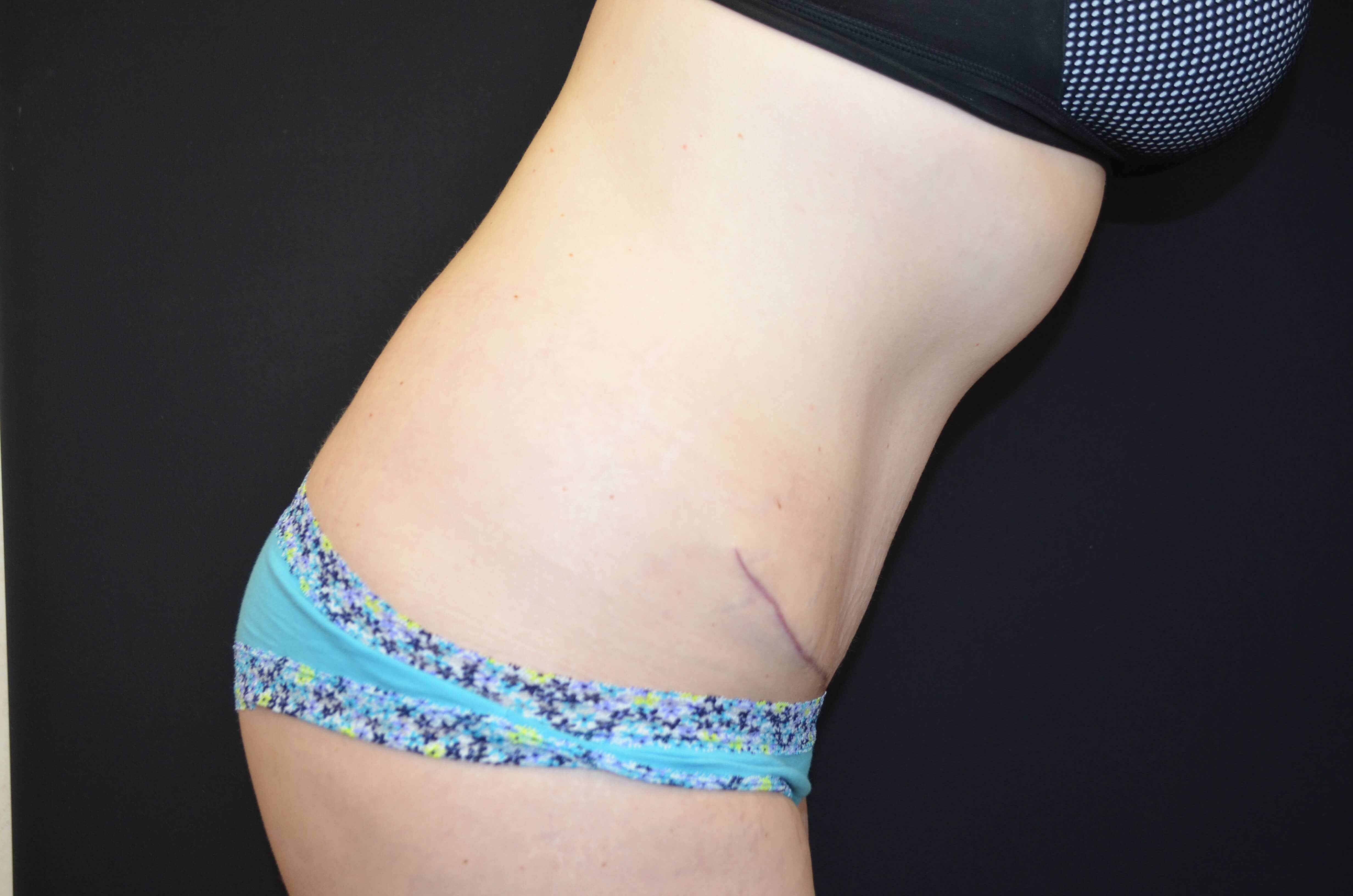 Tummy Tuck & Liposuction After