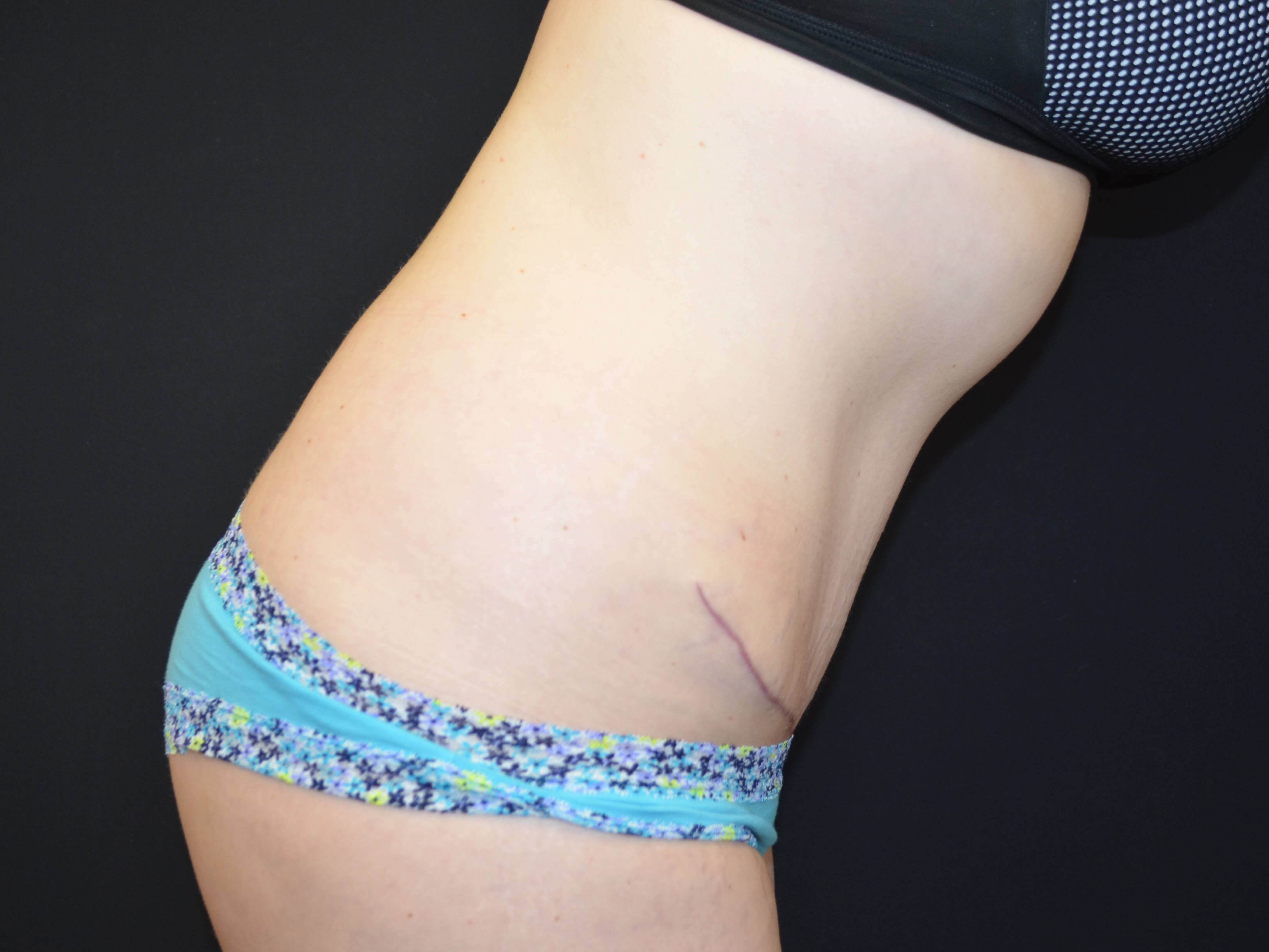 Tummy Tuck & Liposuction After