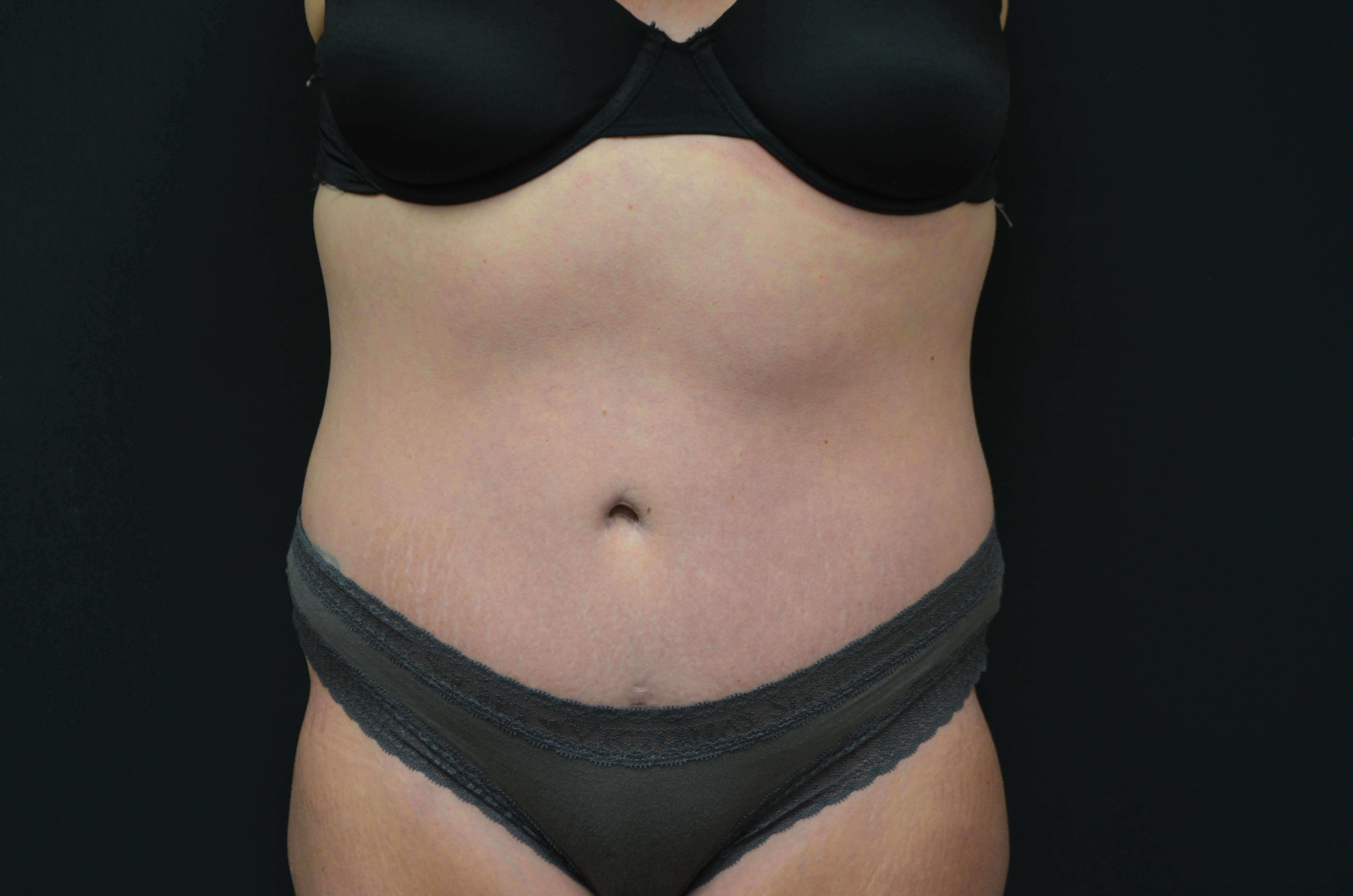 Tummy Tuck Scar After