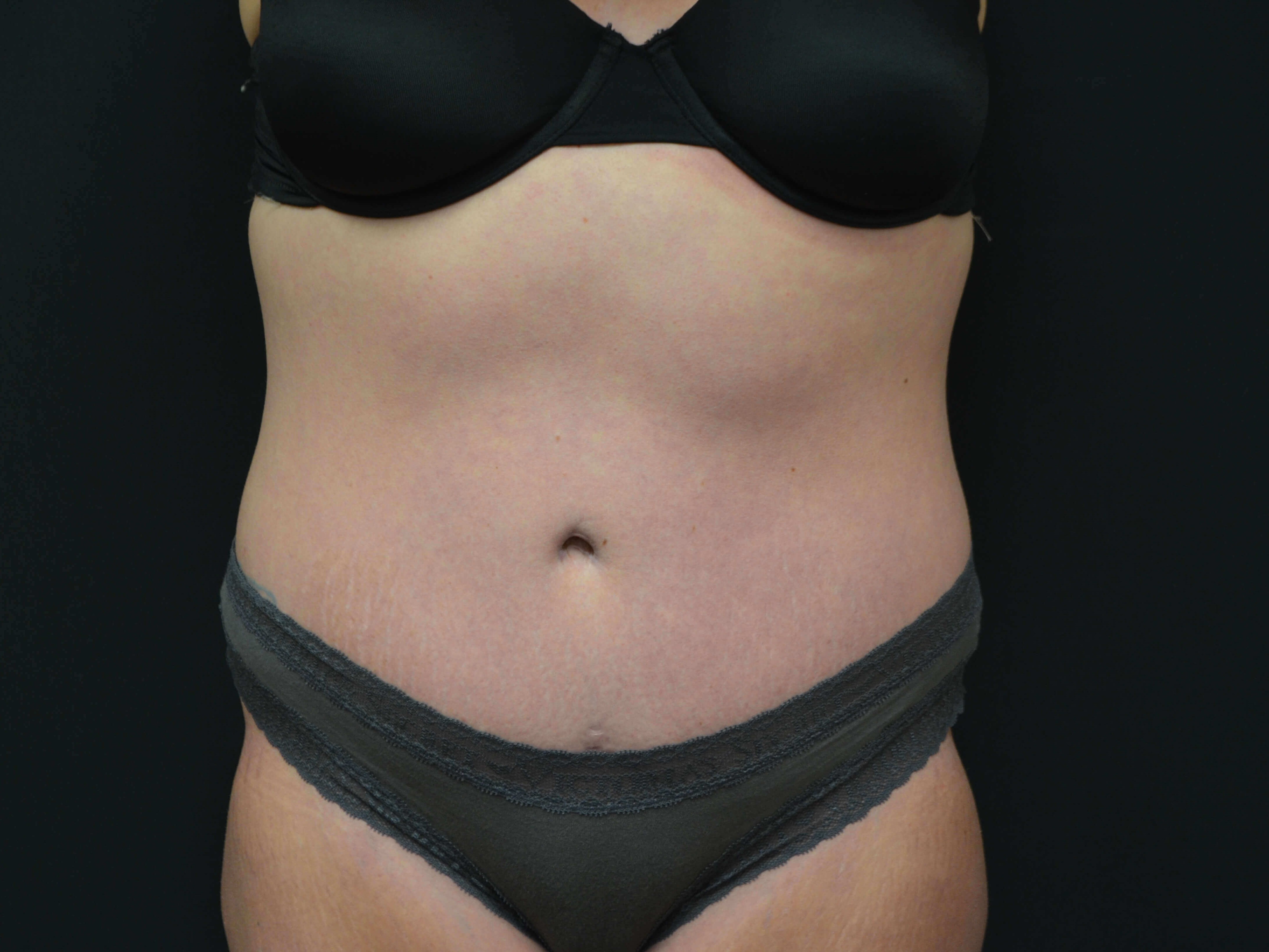 Tummy Tuck Scar After