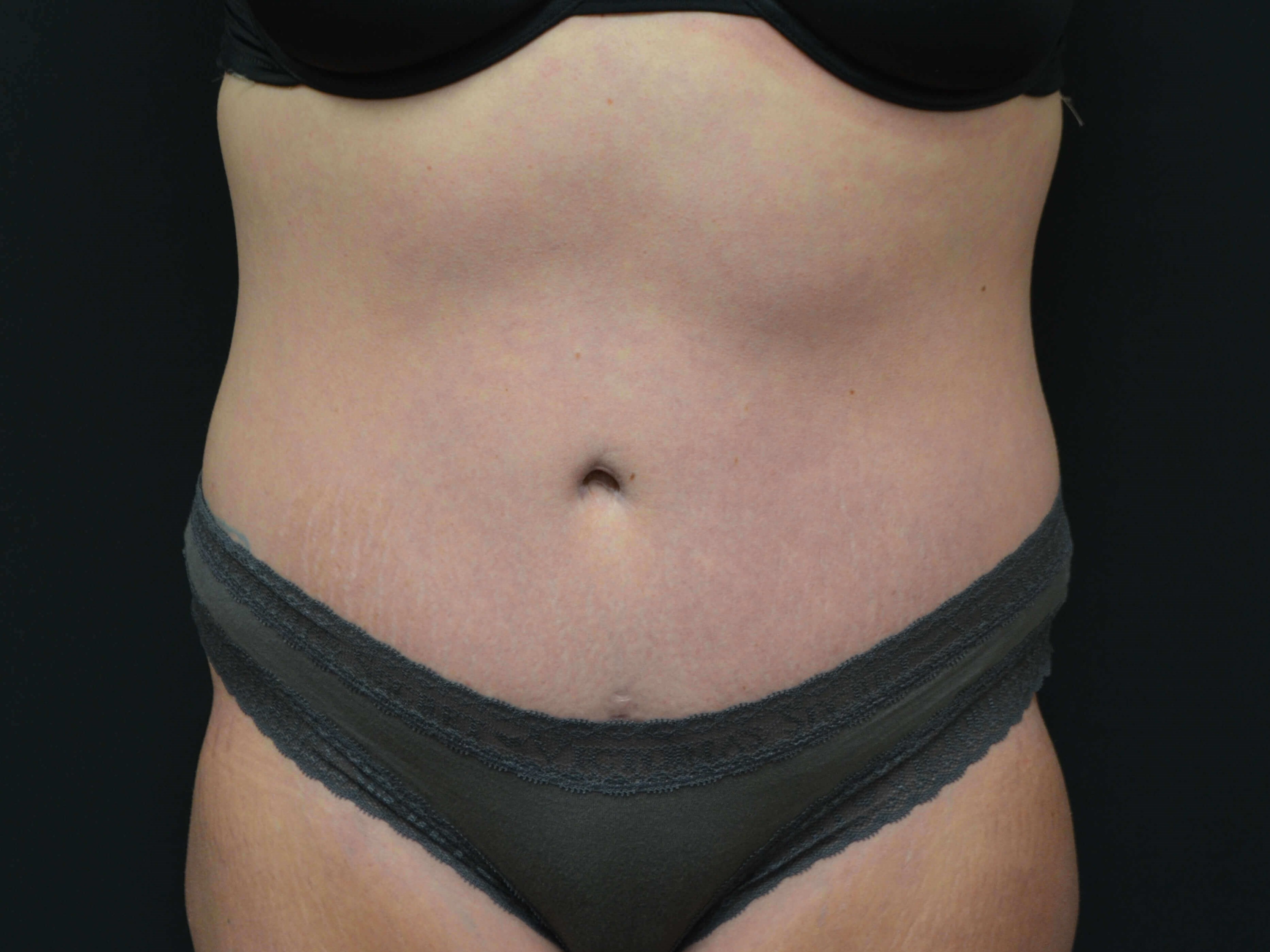 Tummy Tuck & Liposuction After