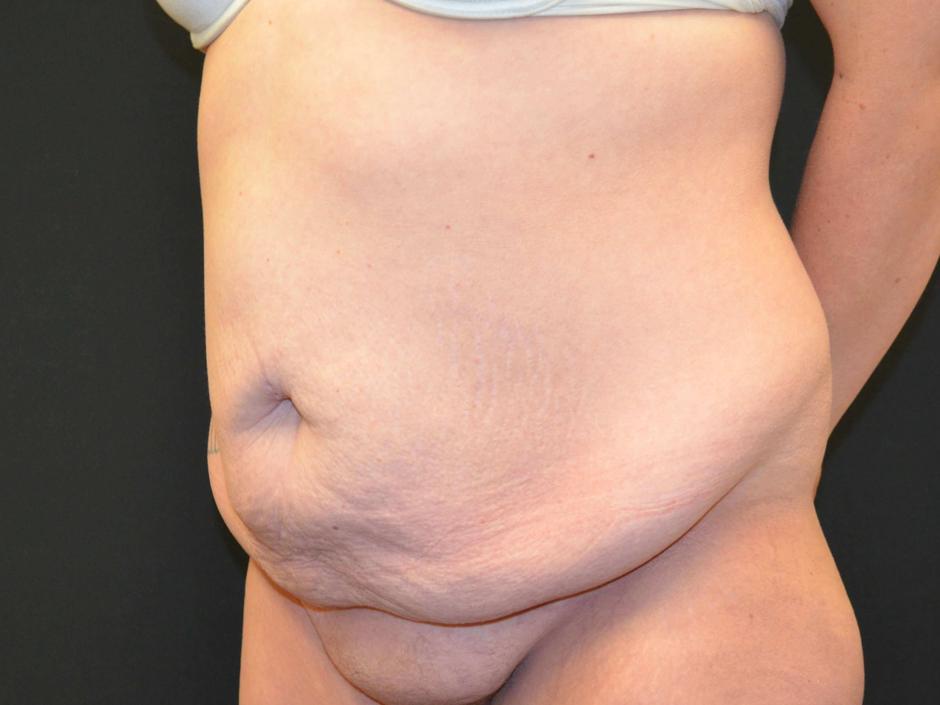 Tummy Tuck & Liposuction Before