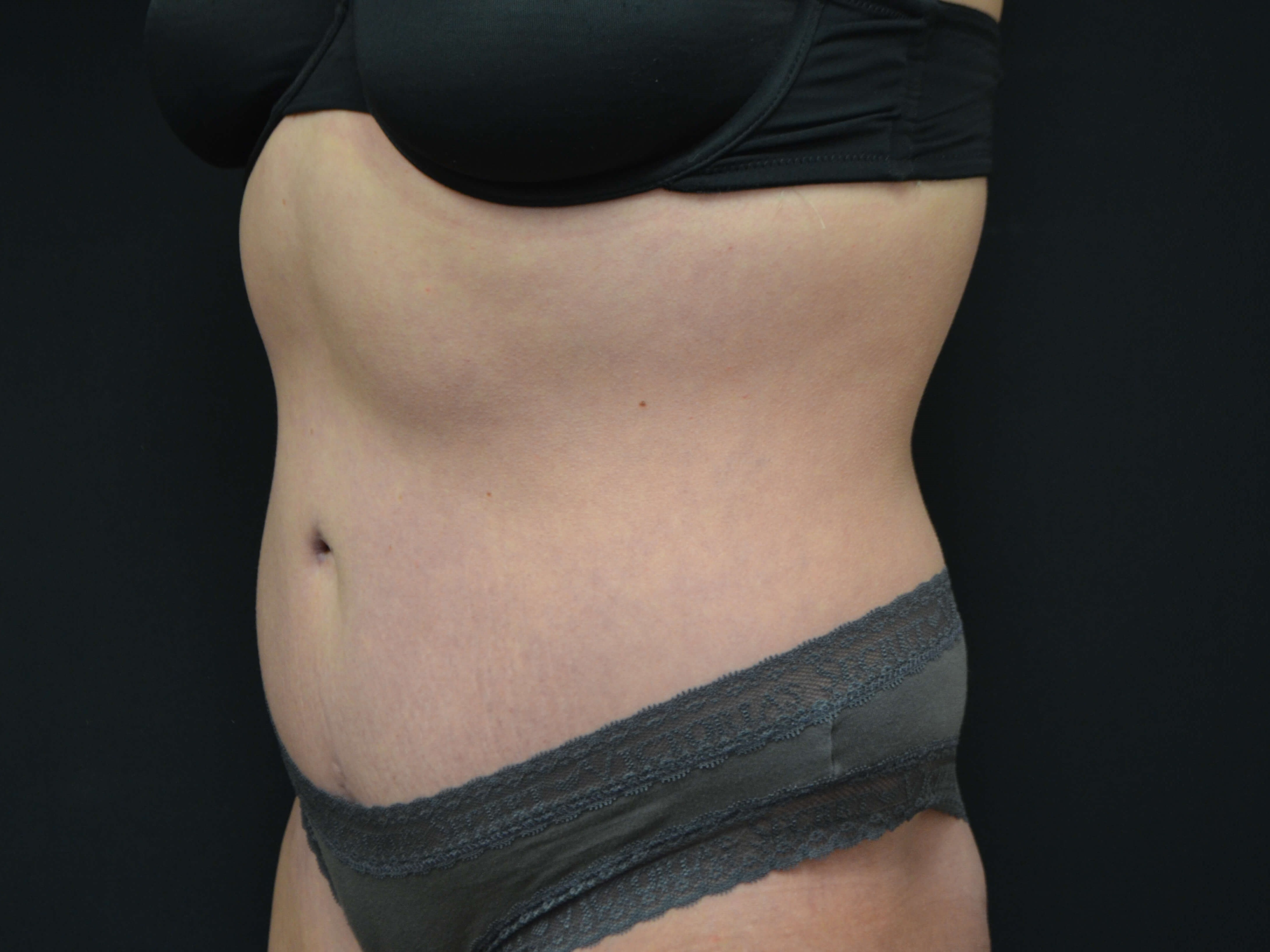 Tummy Tuck & Liposuction After