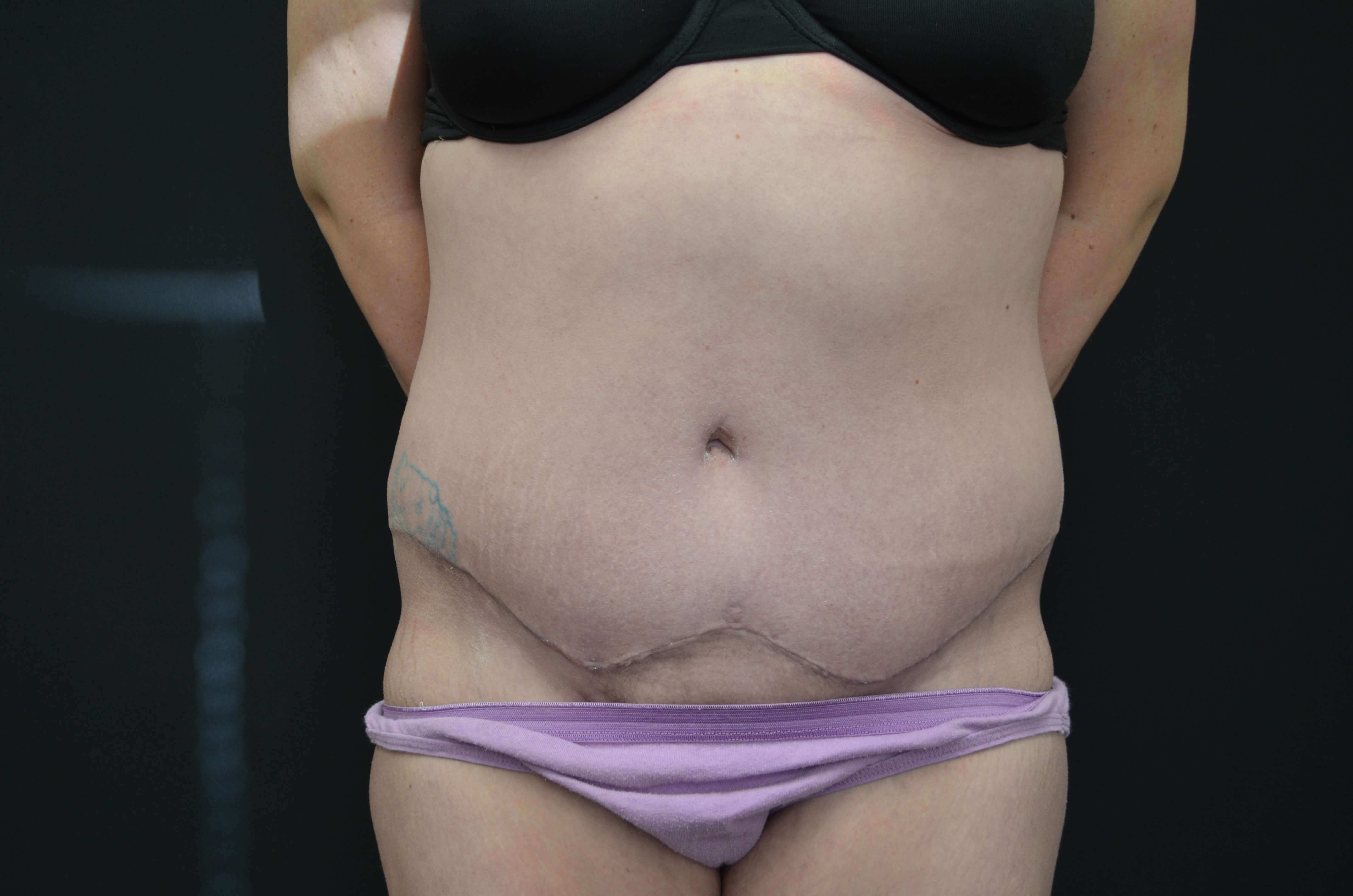 Tummy Tuck Scar After
