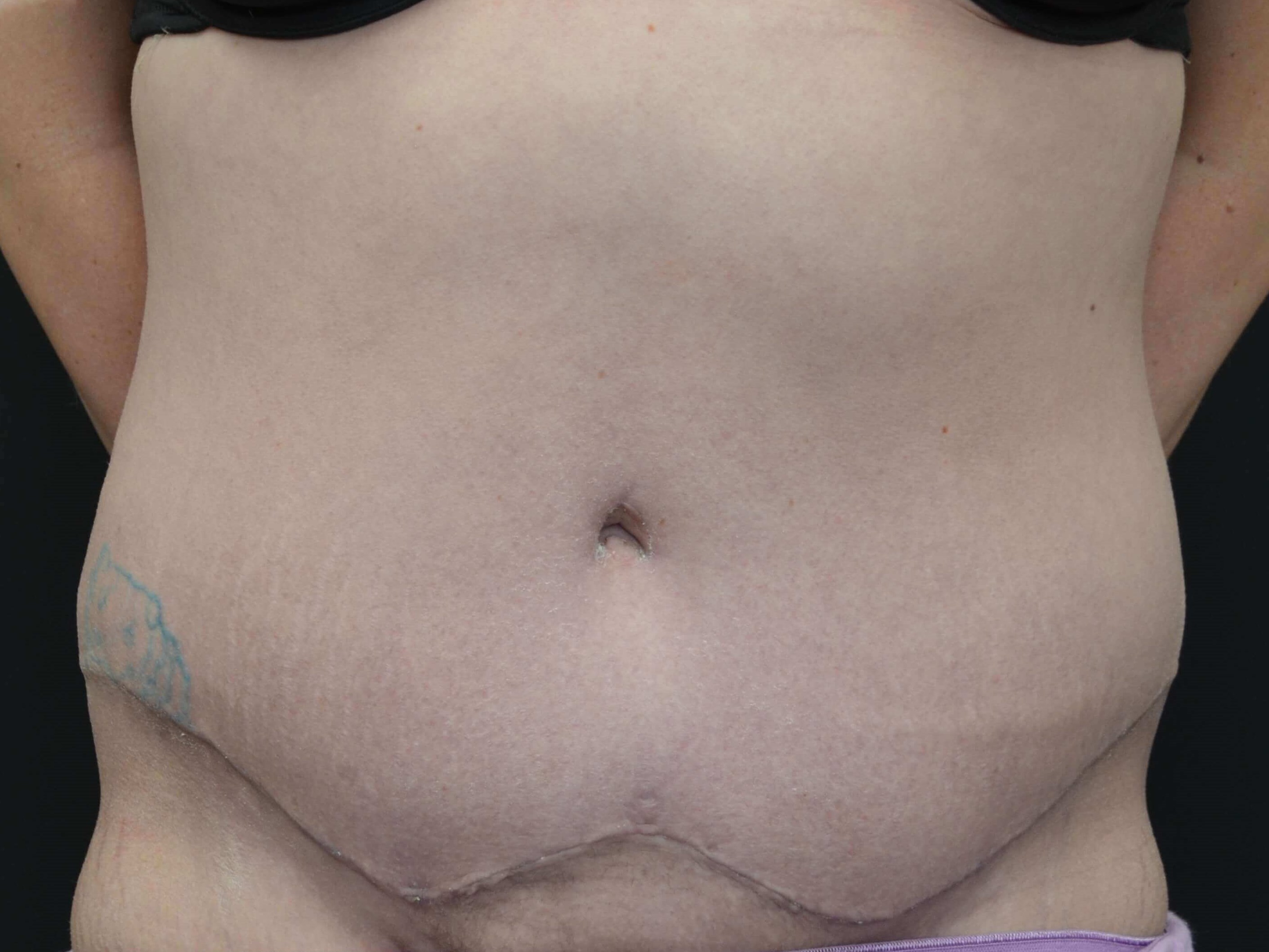 Tummy Tuck Scar After
