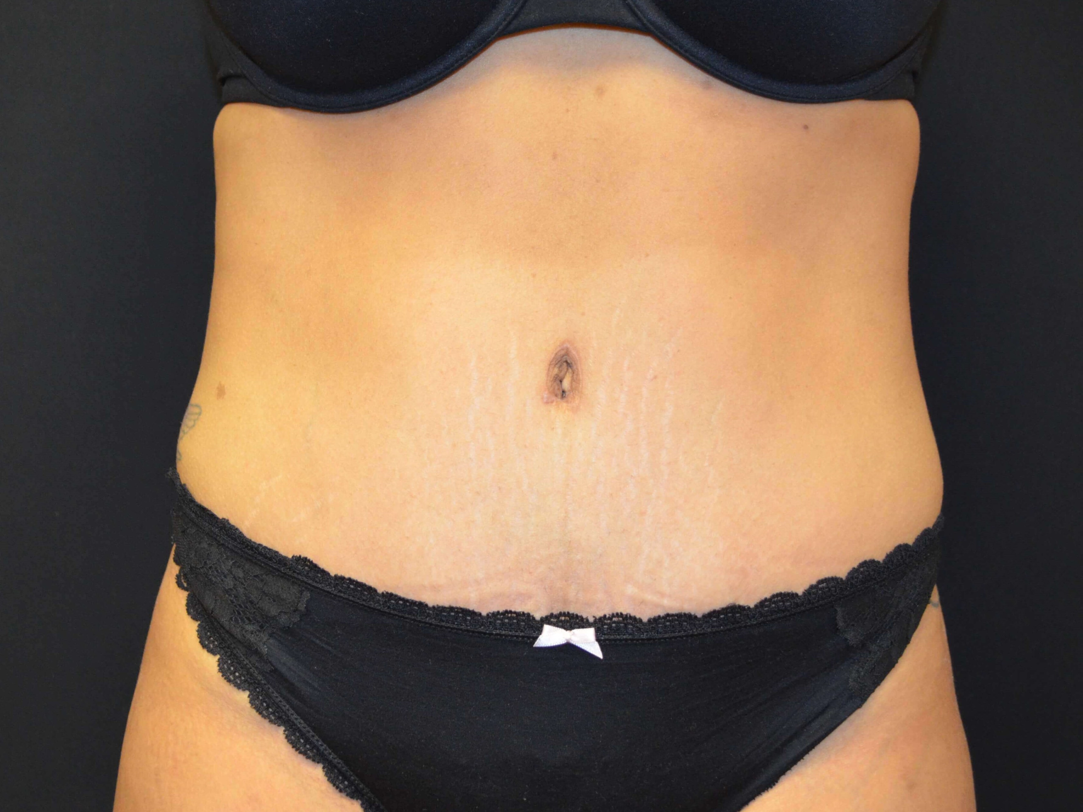 Tummy Tuck- Hinsdale, IL After