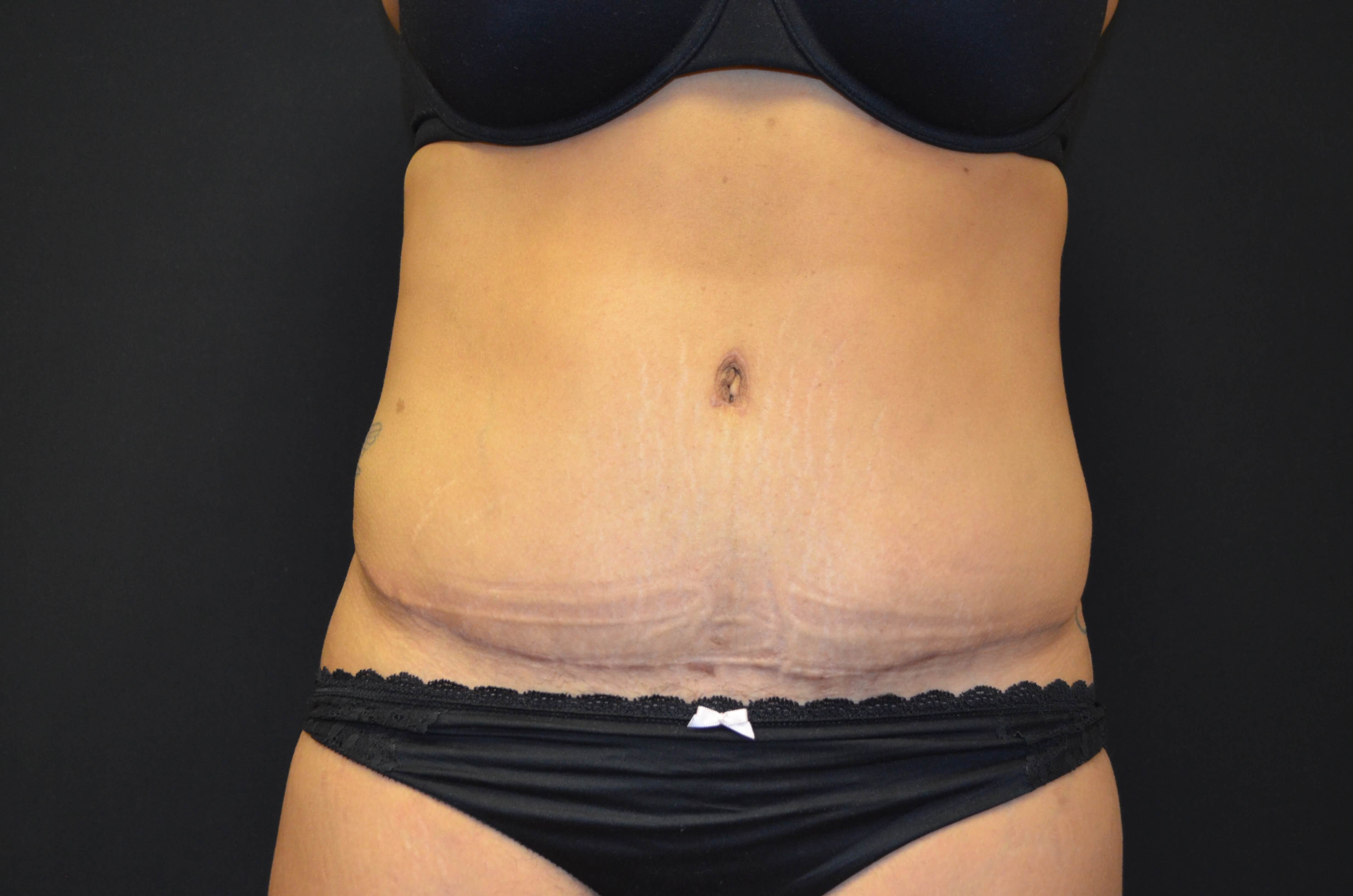 Tummy Tuck- Hinsdale, IL After