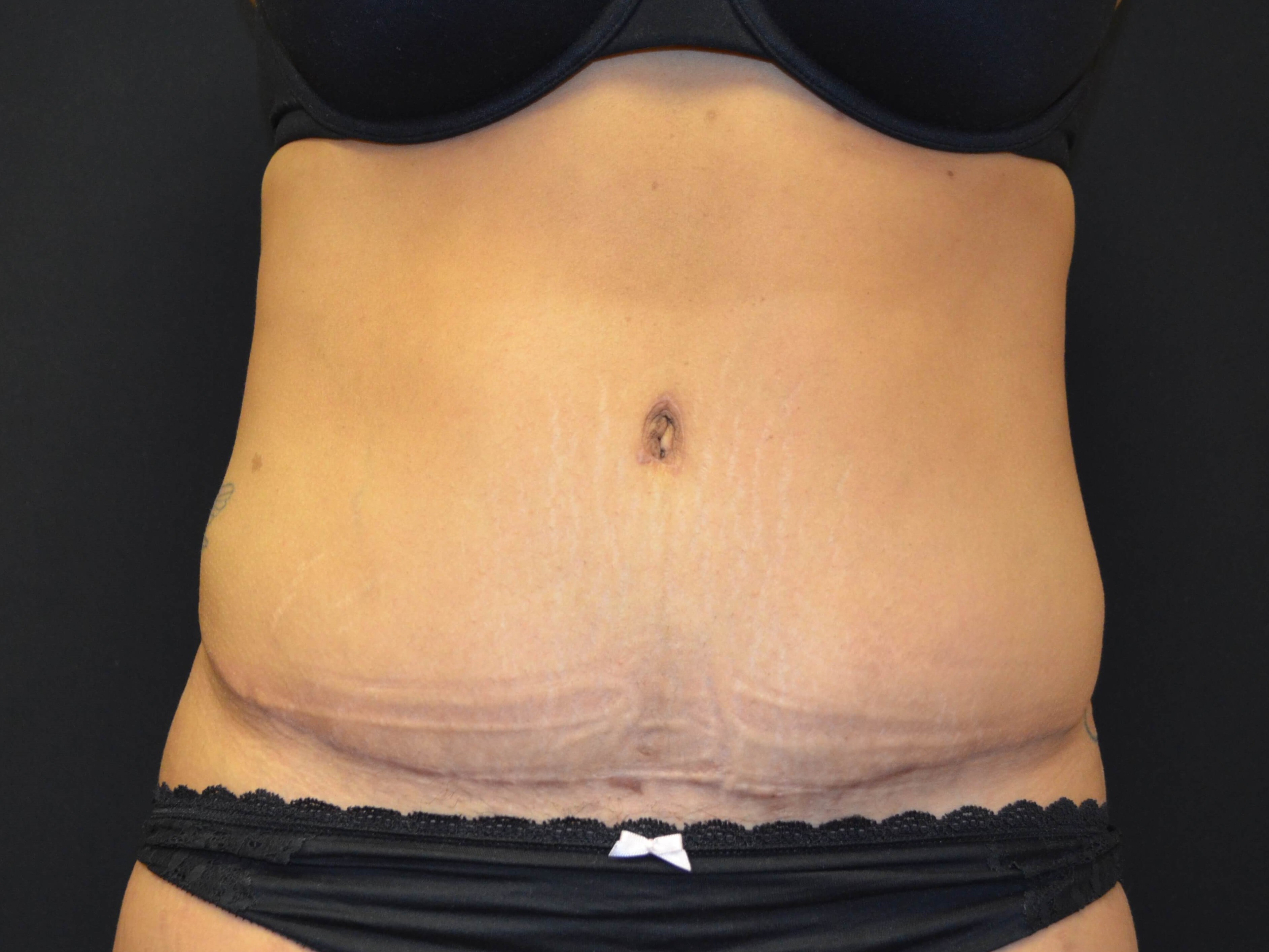 Tummy Tuck- Hinsdale, IL After