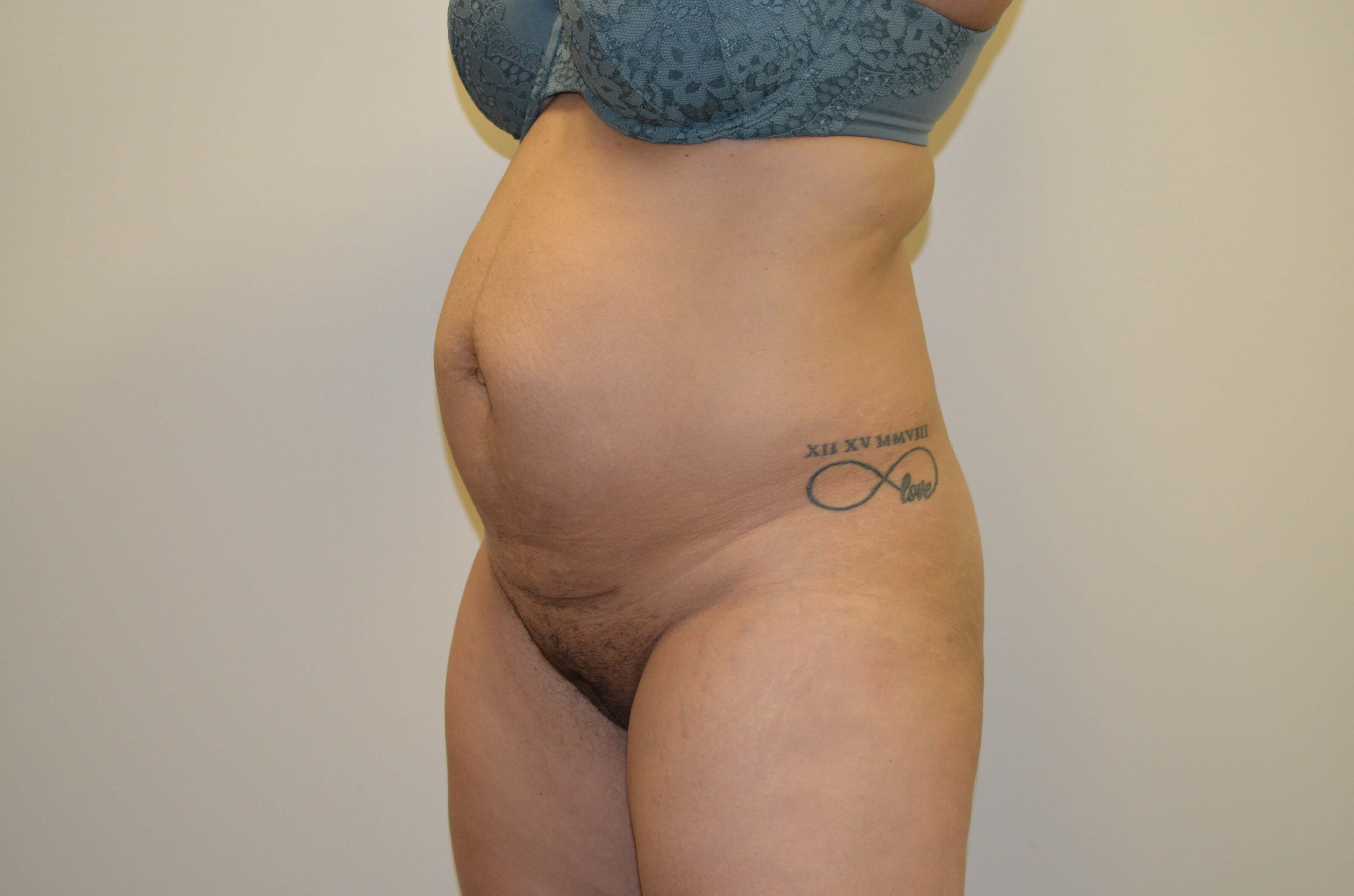 Tummy Tuck- Hinsdale, IL Before