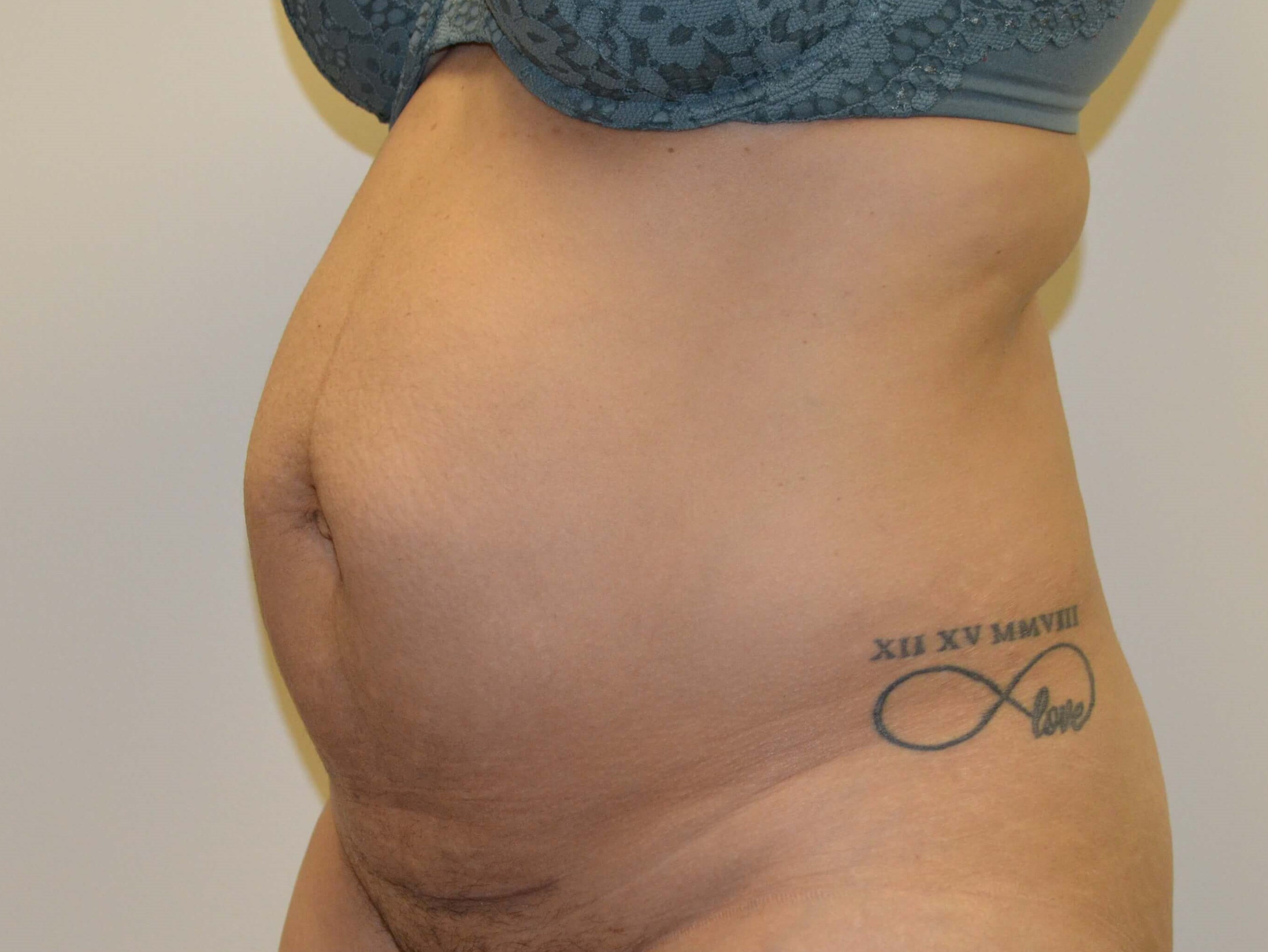 Tummy Tuck- Hinsdale, IL Before