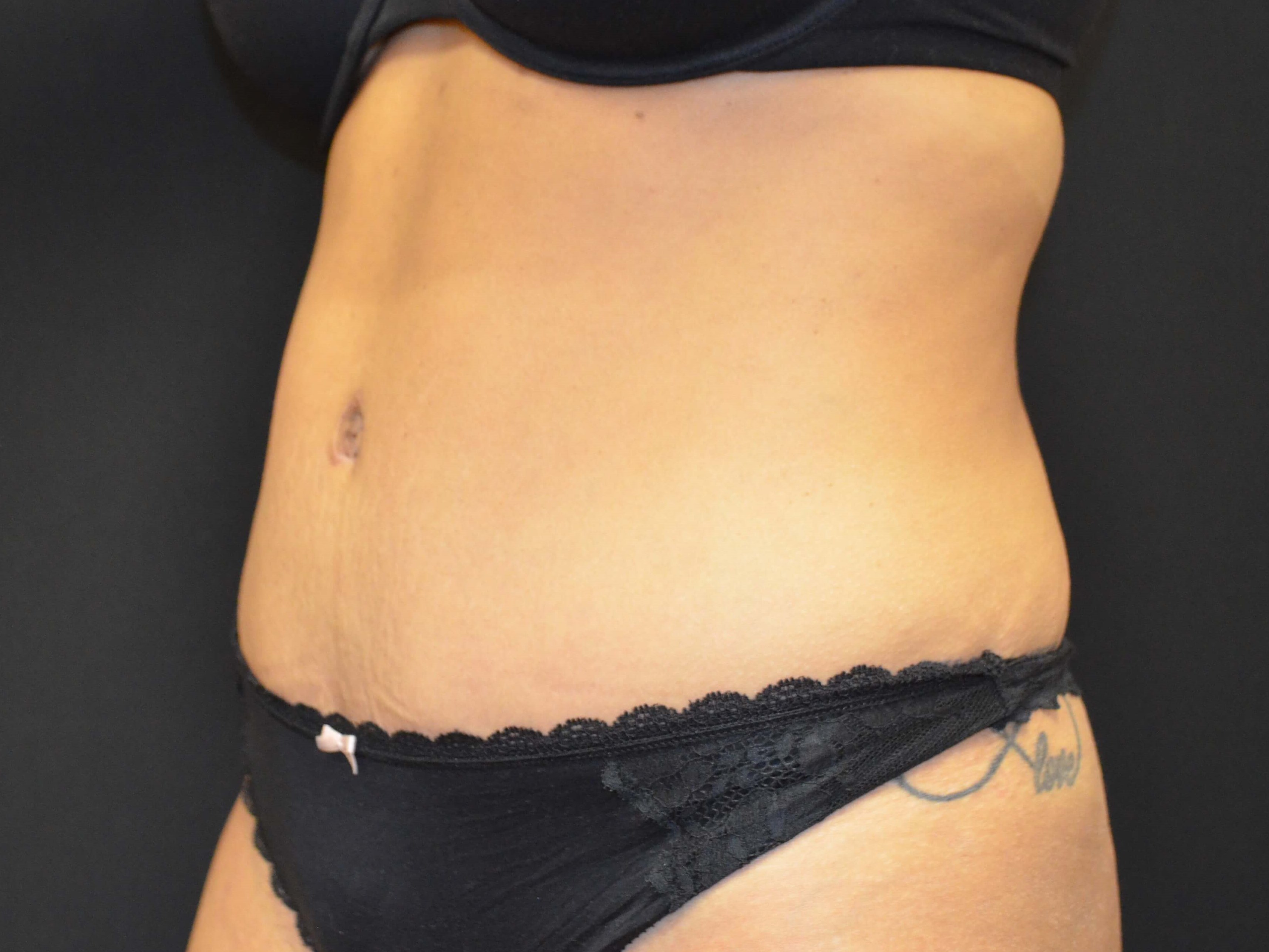 Tummy Tuck- Hinsdale, IL After