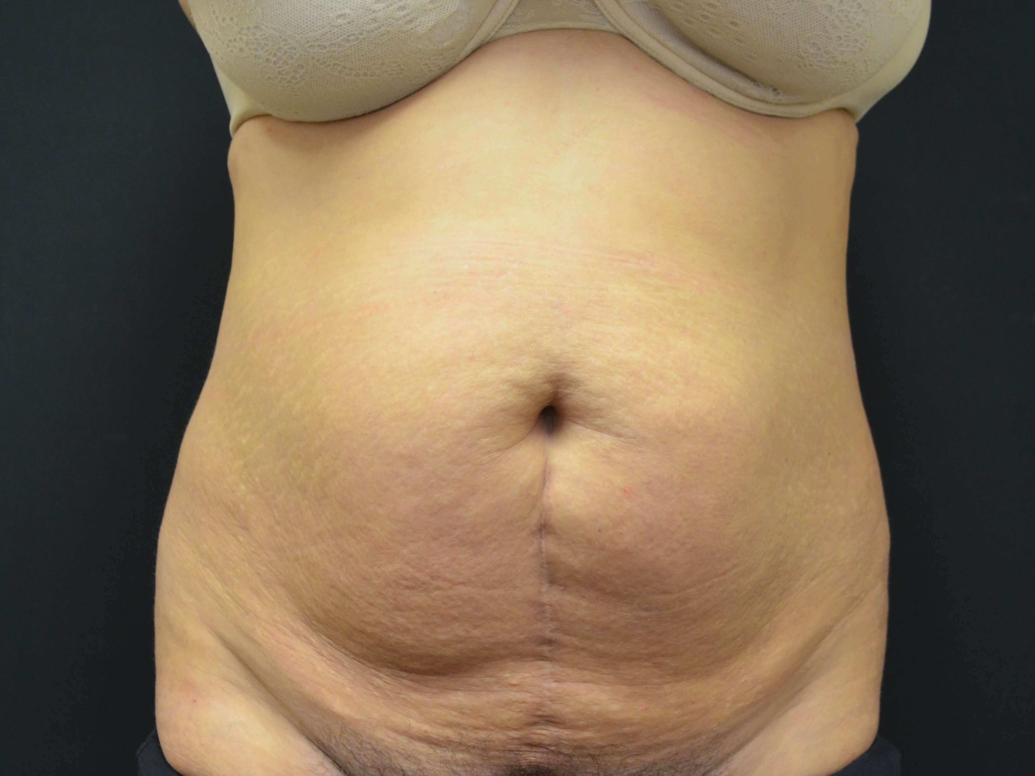 Tummy Tuck- Hinsdale, IL Before