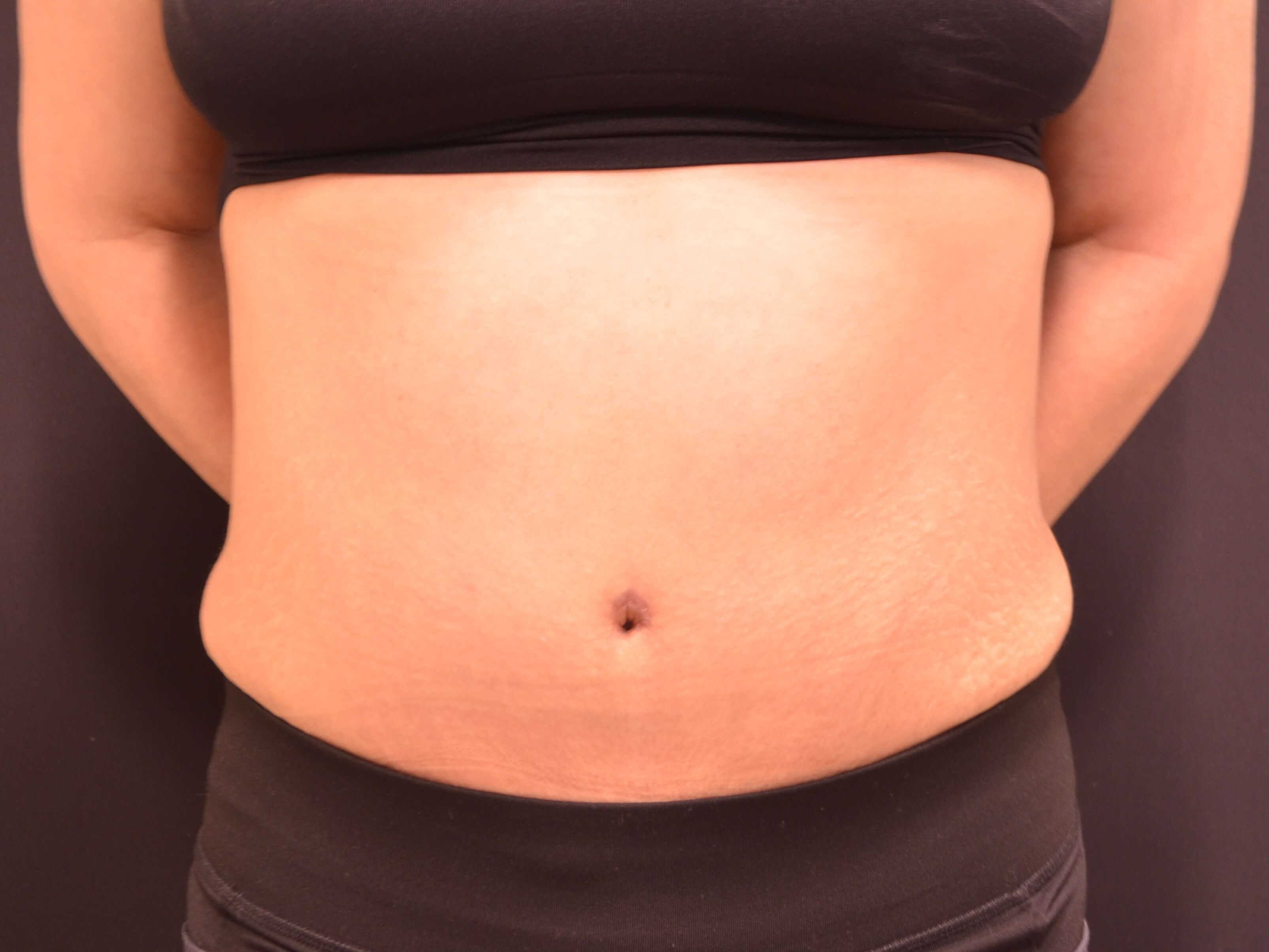 Tummy Tuck- Hinsdale, IL After