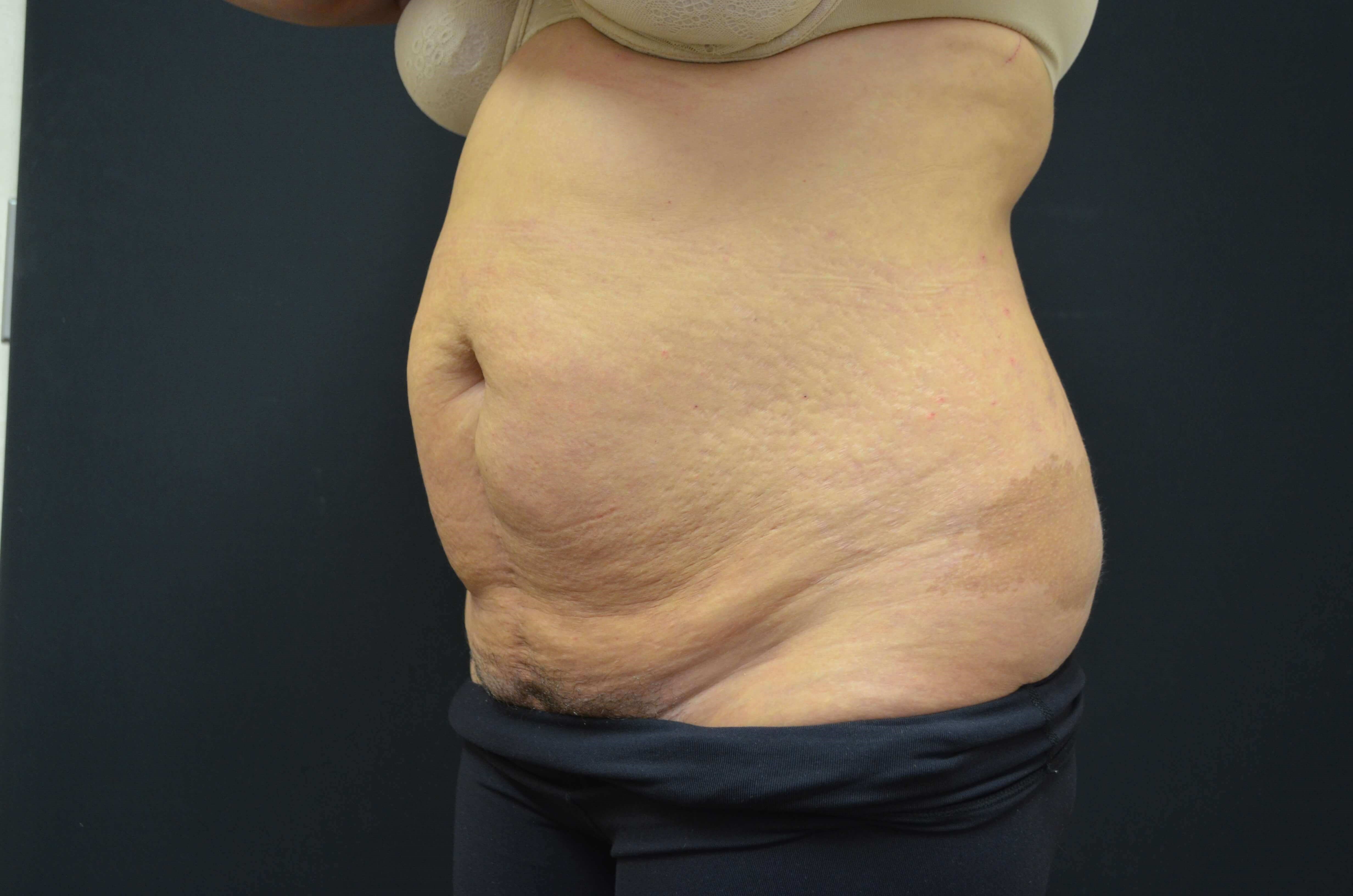 Tummy Tuck- Hinsdale, IL Before