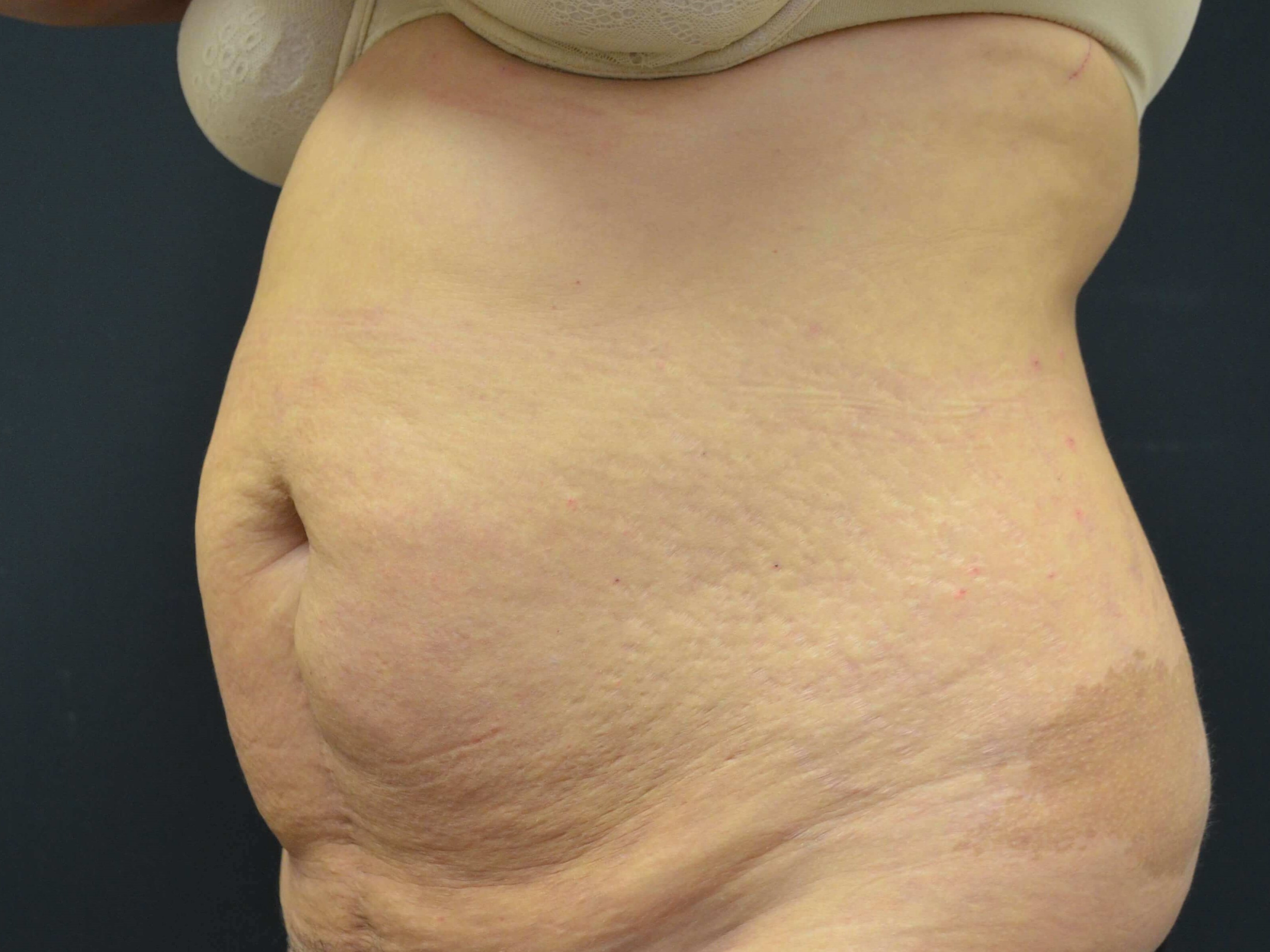 Tummy Tuck- Hinsdale, IL Before
