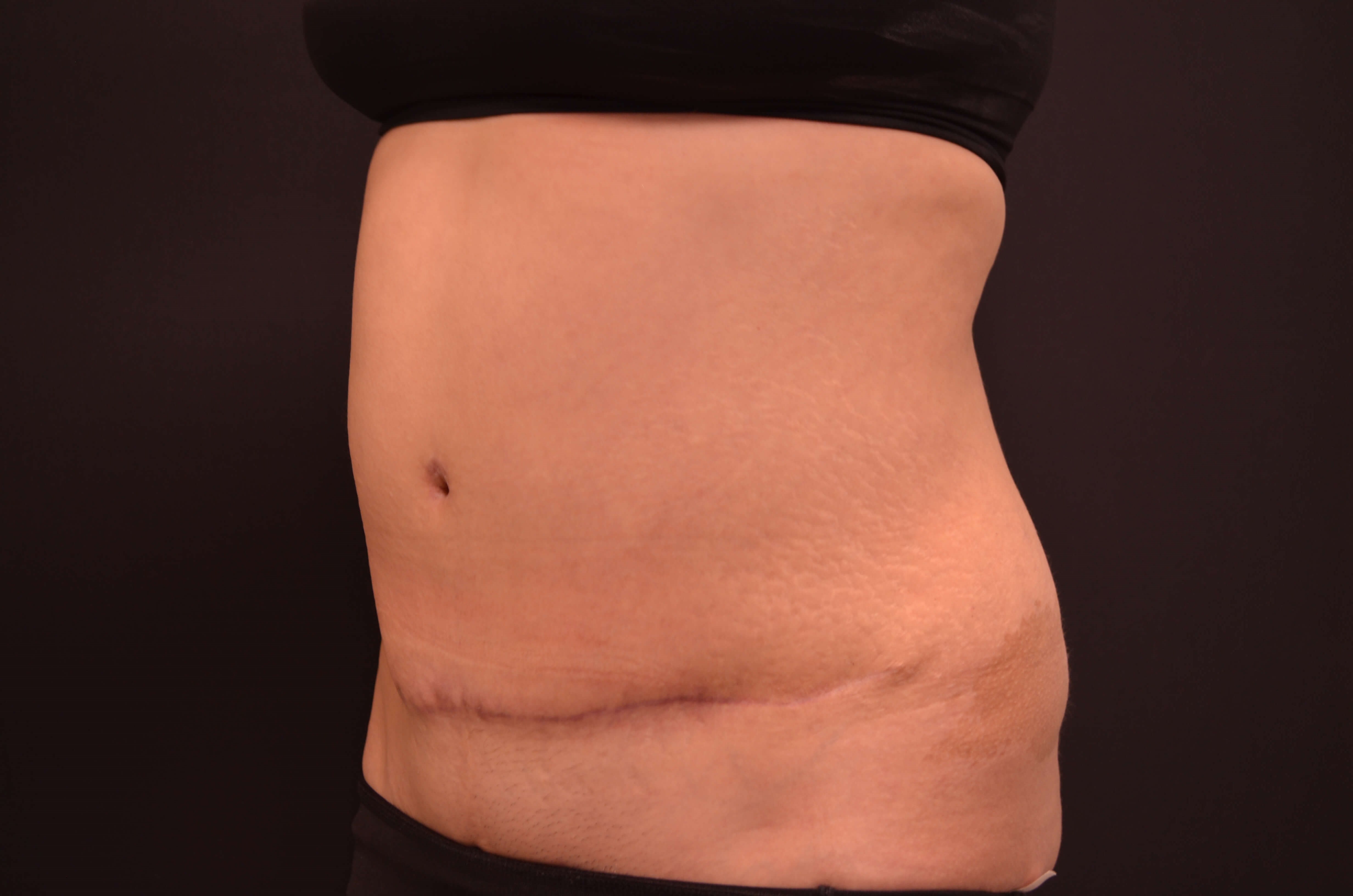 Tummy Tuck- Hinsdale, IL After