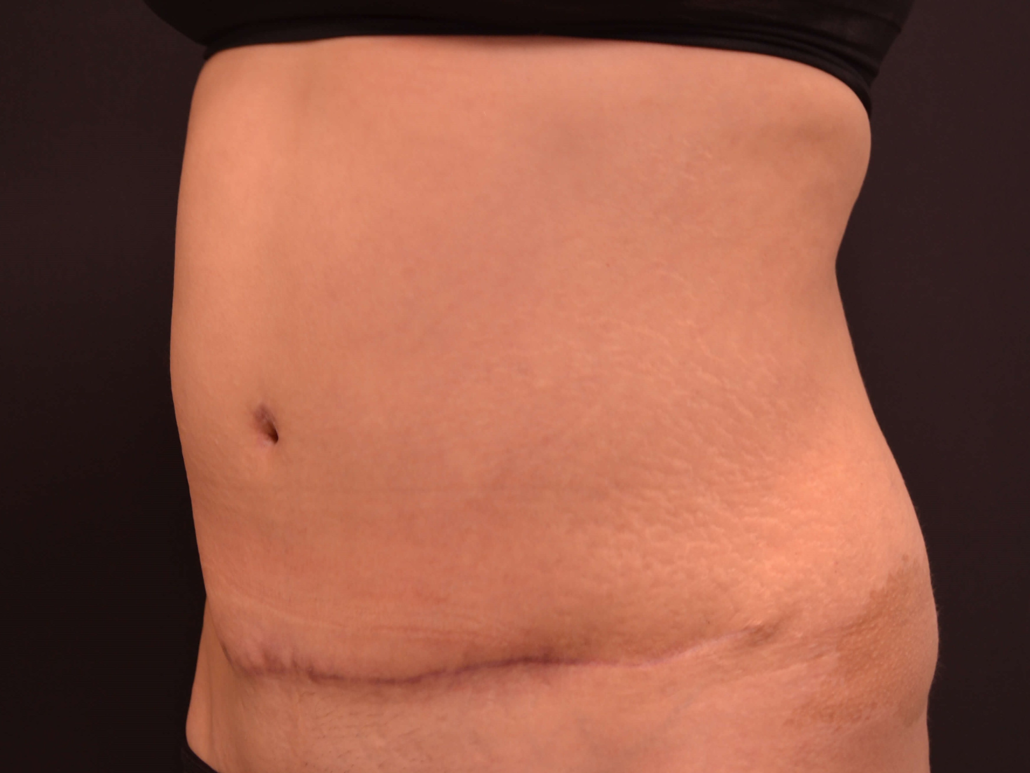 Tummy Tuck- Hinsdale, IL After