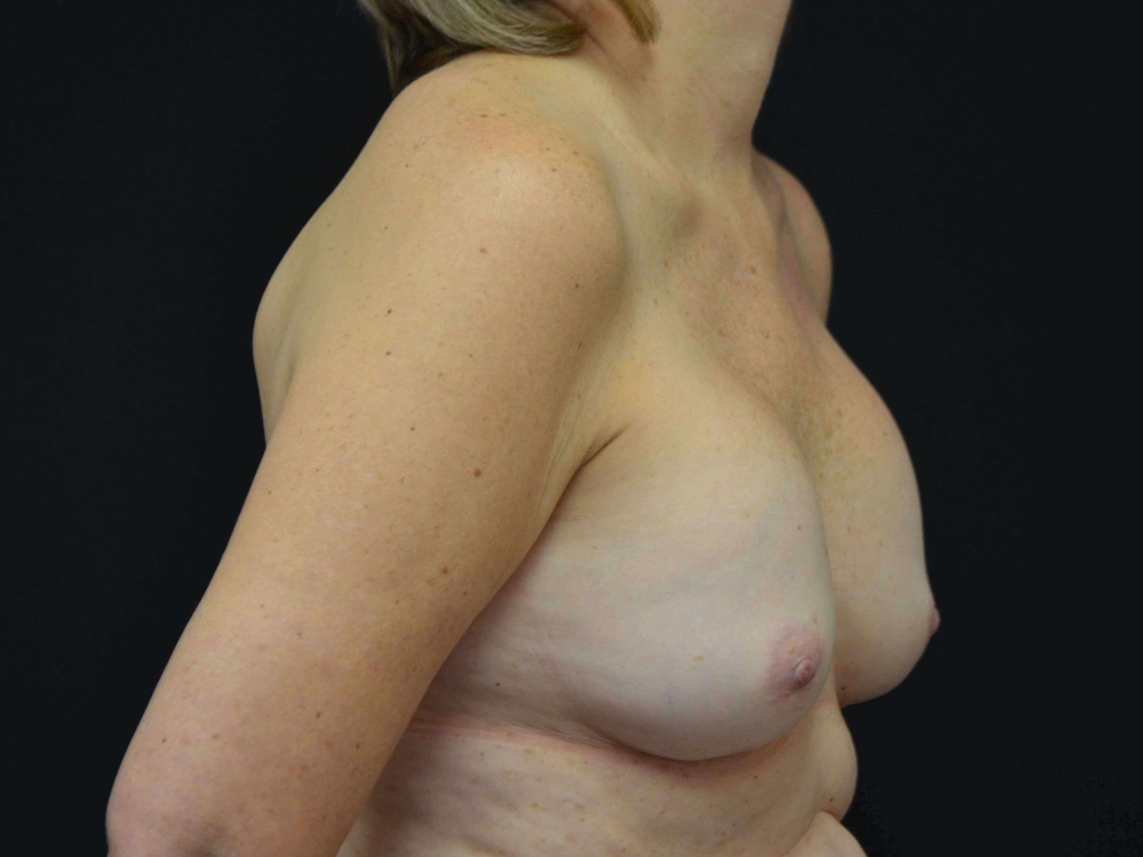 Breast Implant Revision Before