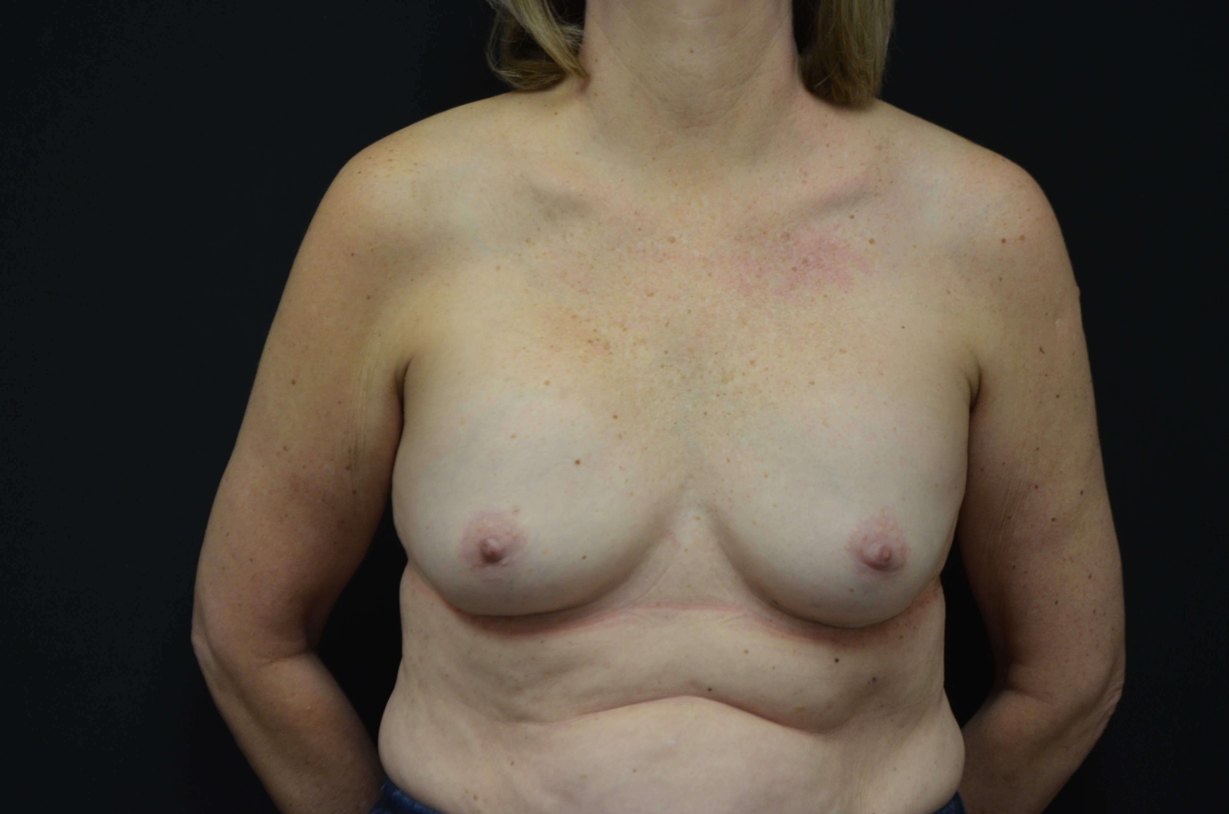 Breast Implant Revision Before