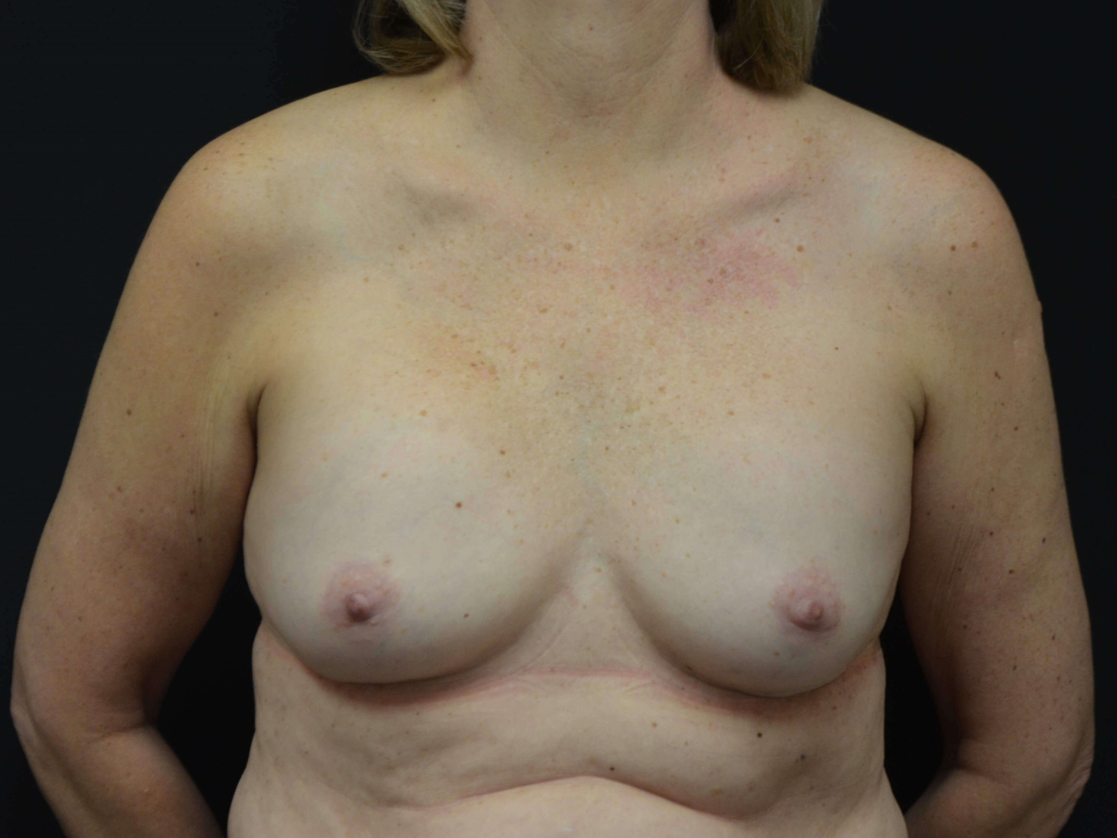 Breast Implant Revision Before