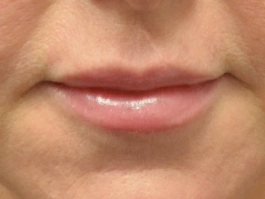 Lip Enhancement with Juvederm After