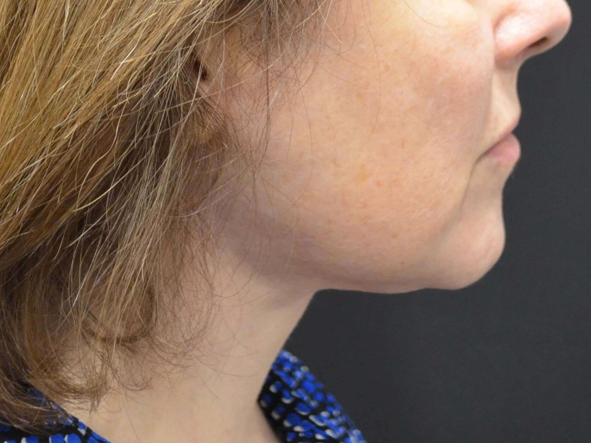 Lower Face Lift- Hinsdale, IL After