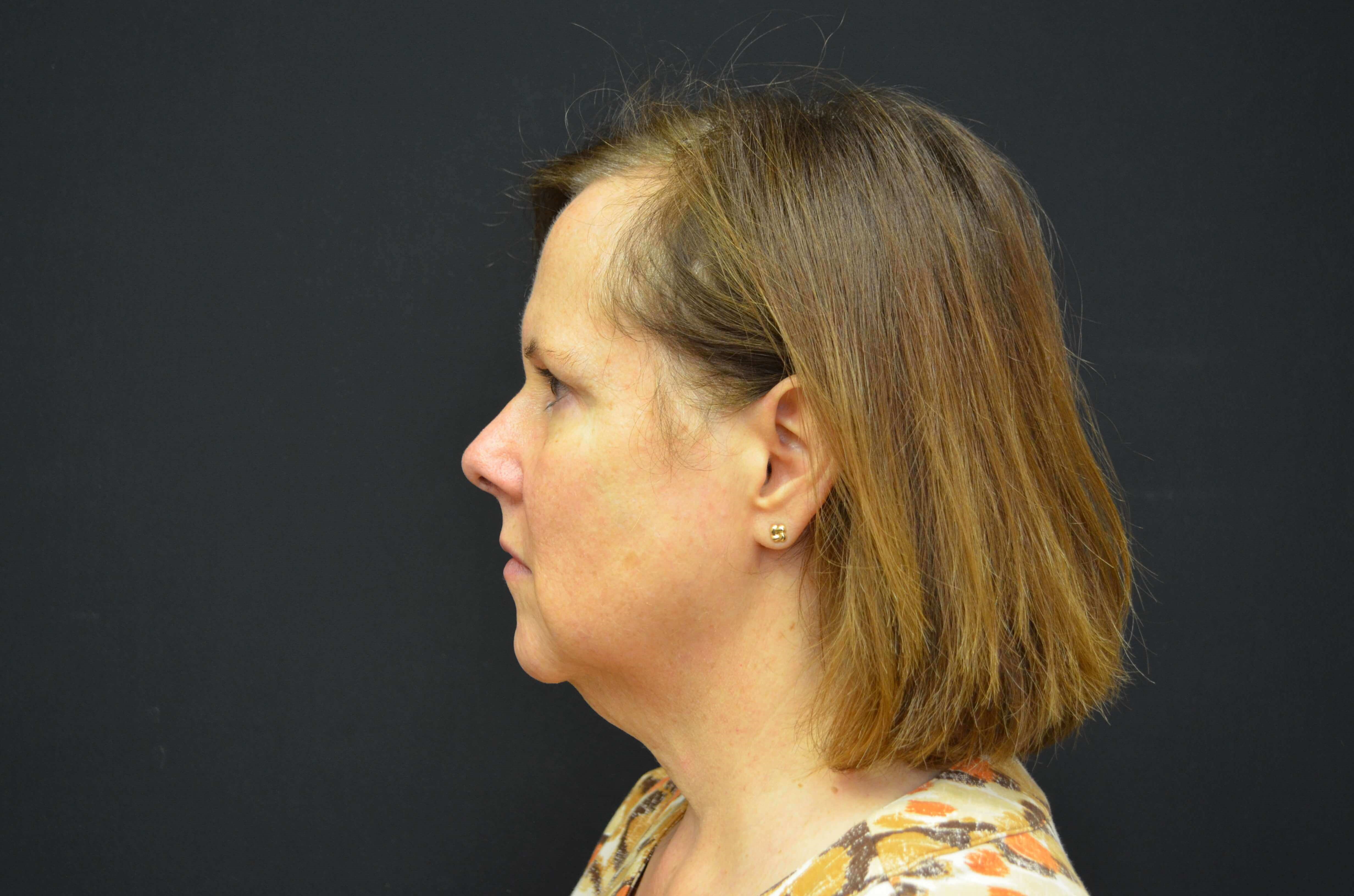 Lower Face Lift- Hinsdale, IL Before