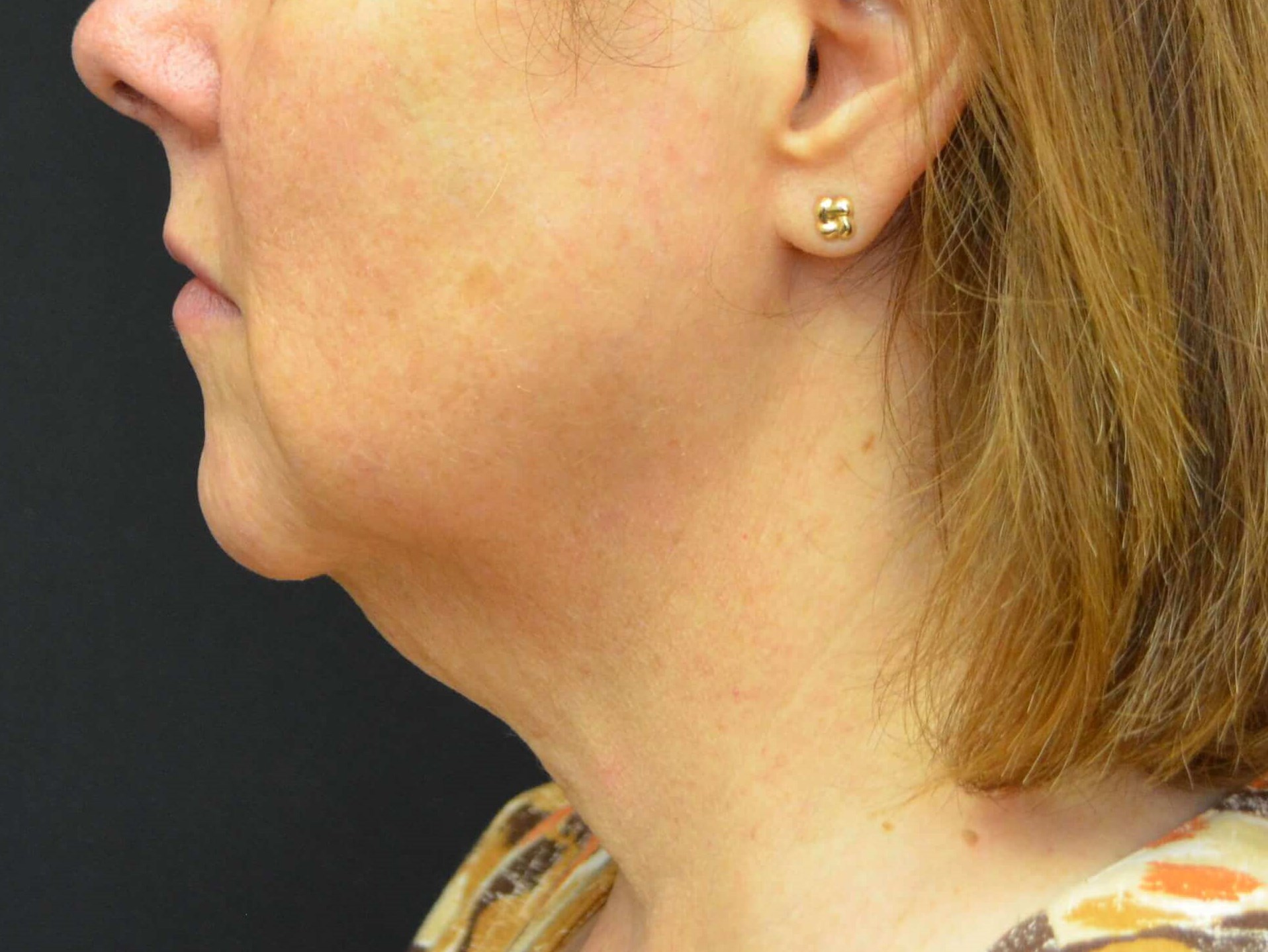 Lower Face Lift- Hinsdale, IL Before