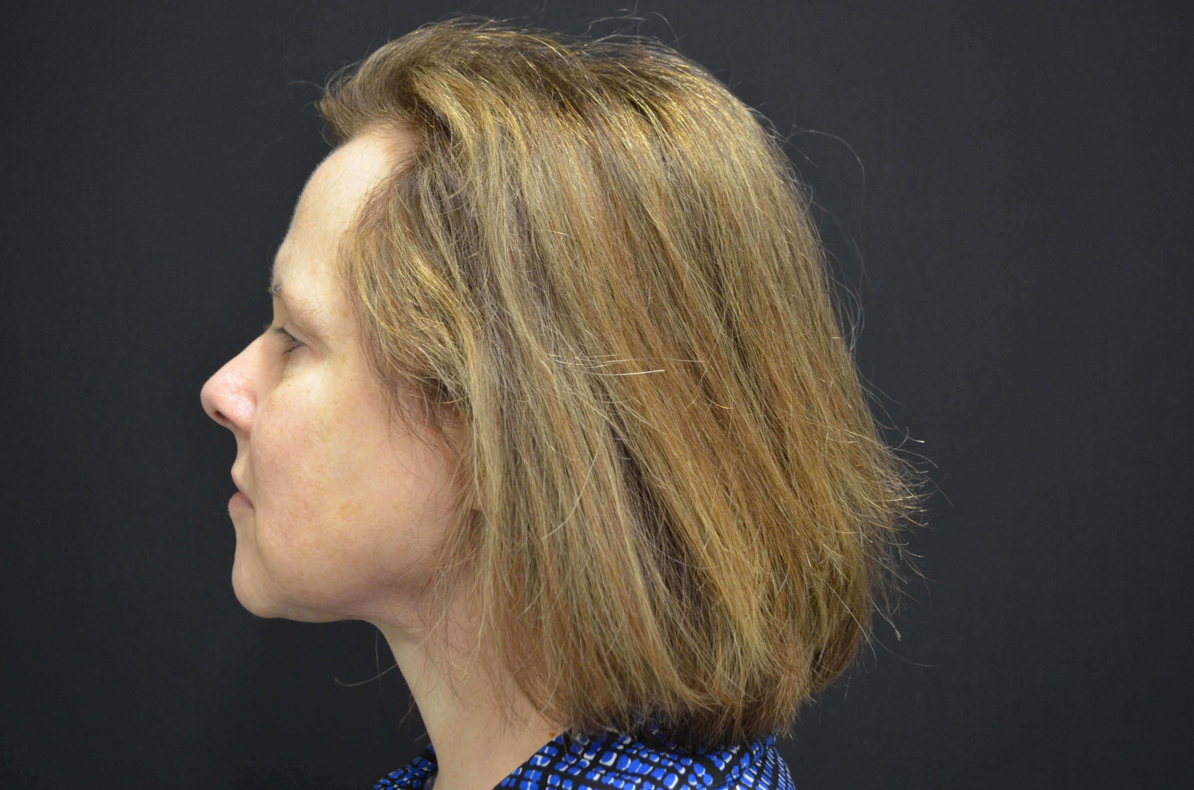 Lower Face Lift- Hinsdale, IL After