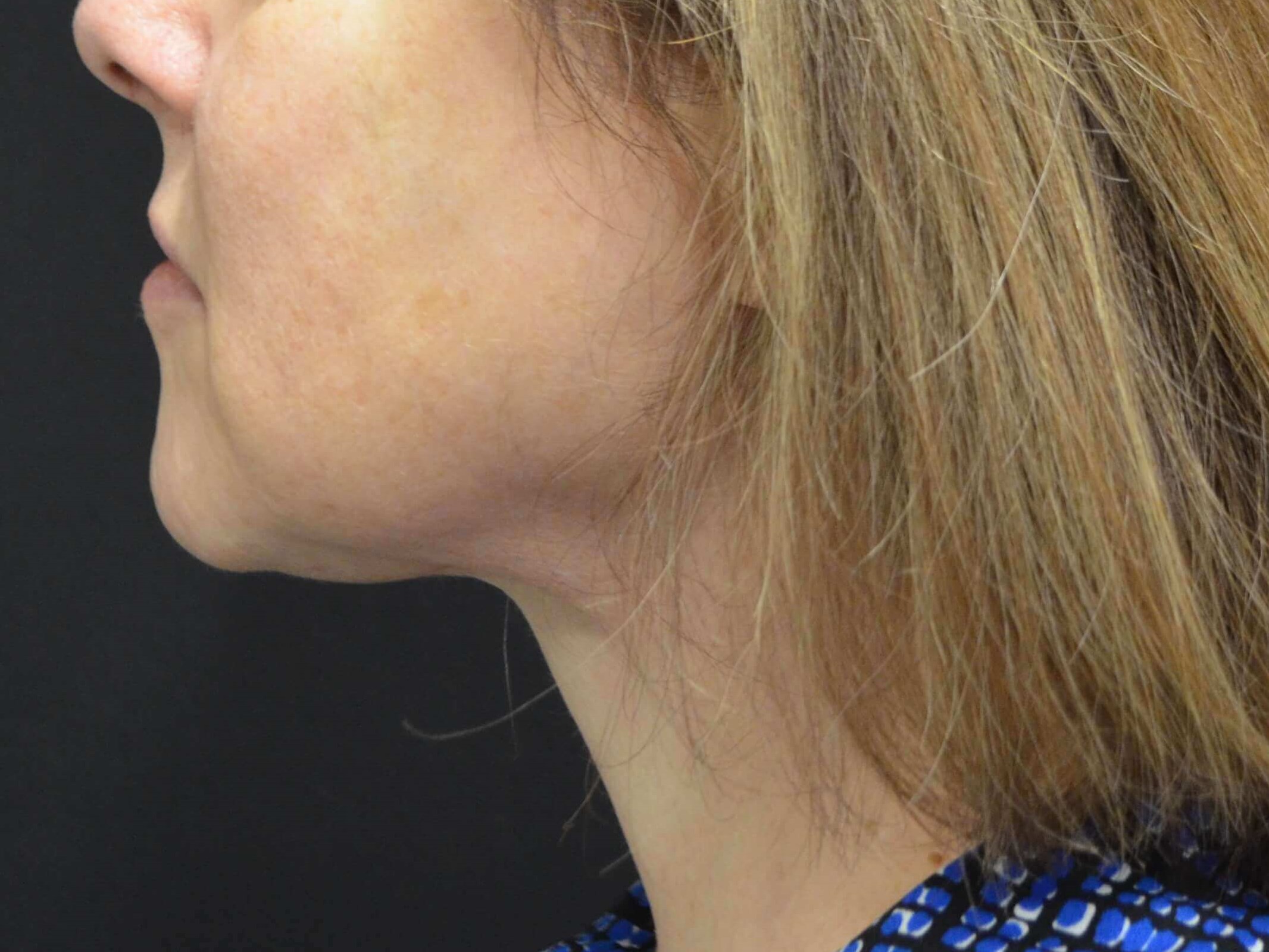 Lower Face Lift- Hinsdale, IL After