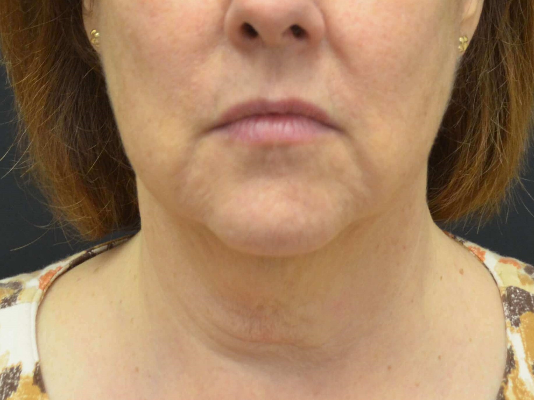 Lower Face Lift- Hinsdale, IL Before
