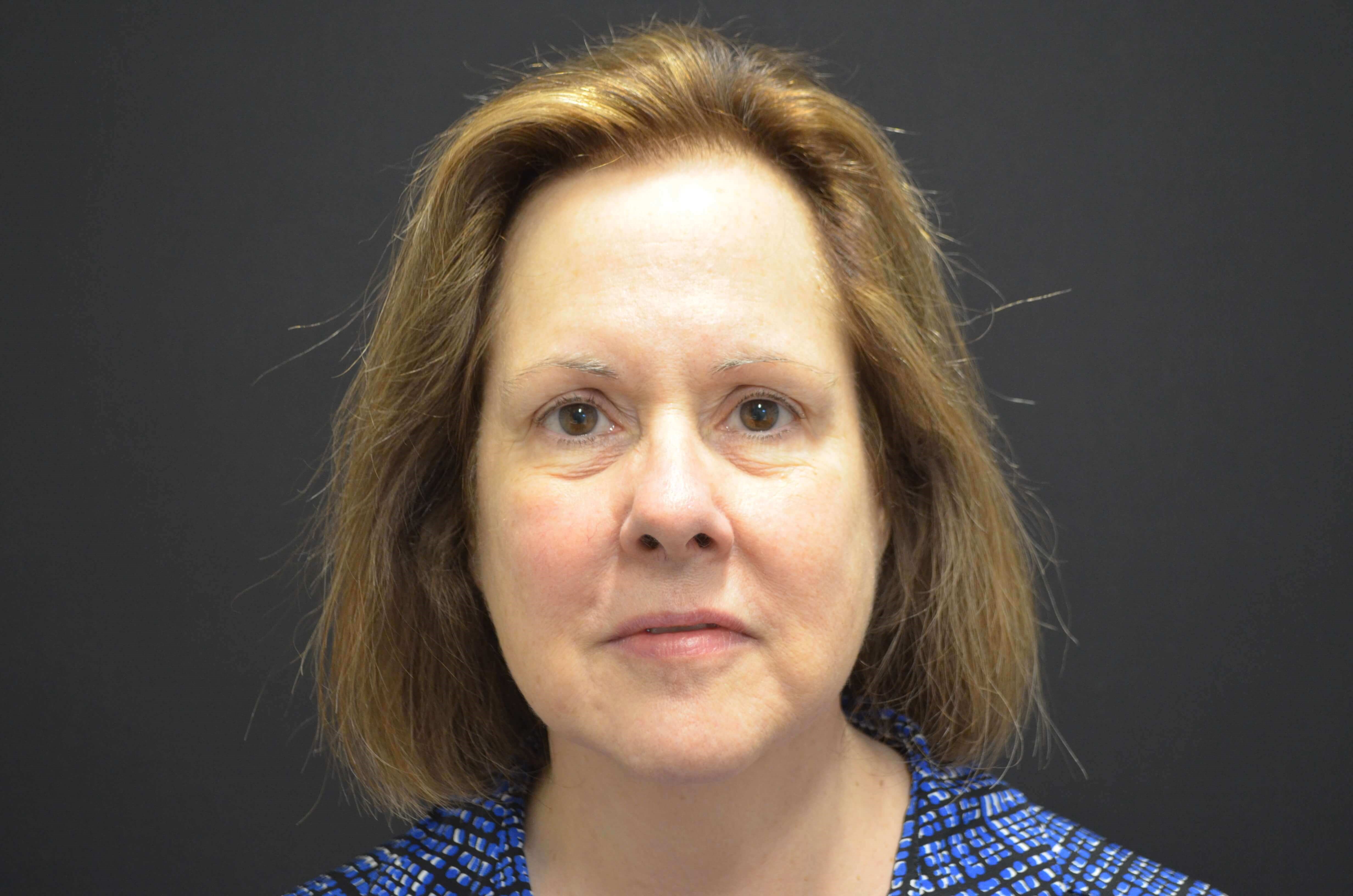 Lower Face Lift- Hinsdale, IL After