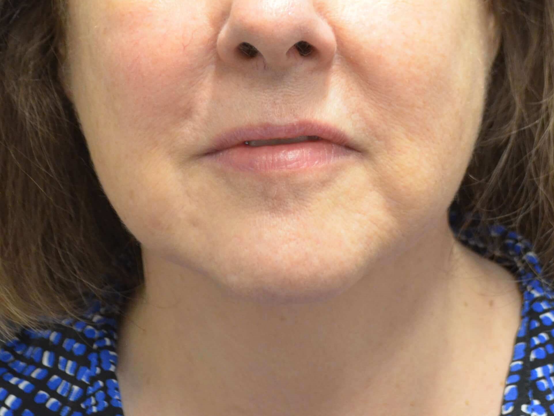 Lower Face Lift- Hinsdale, IL After
