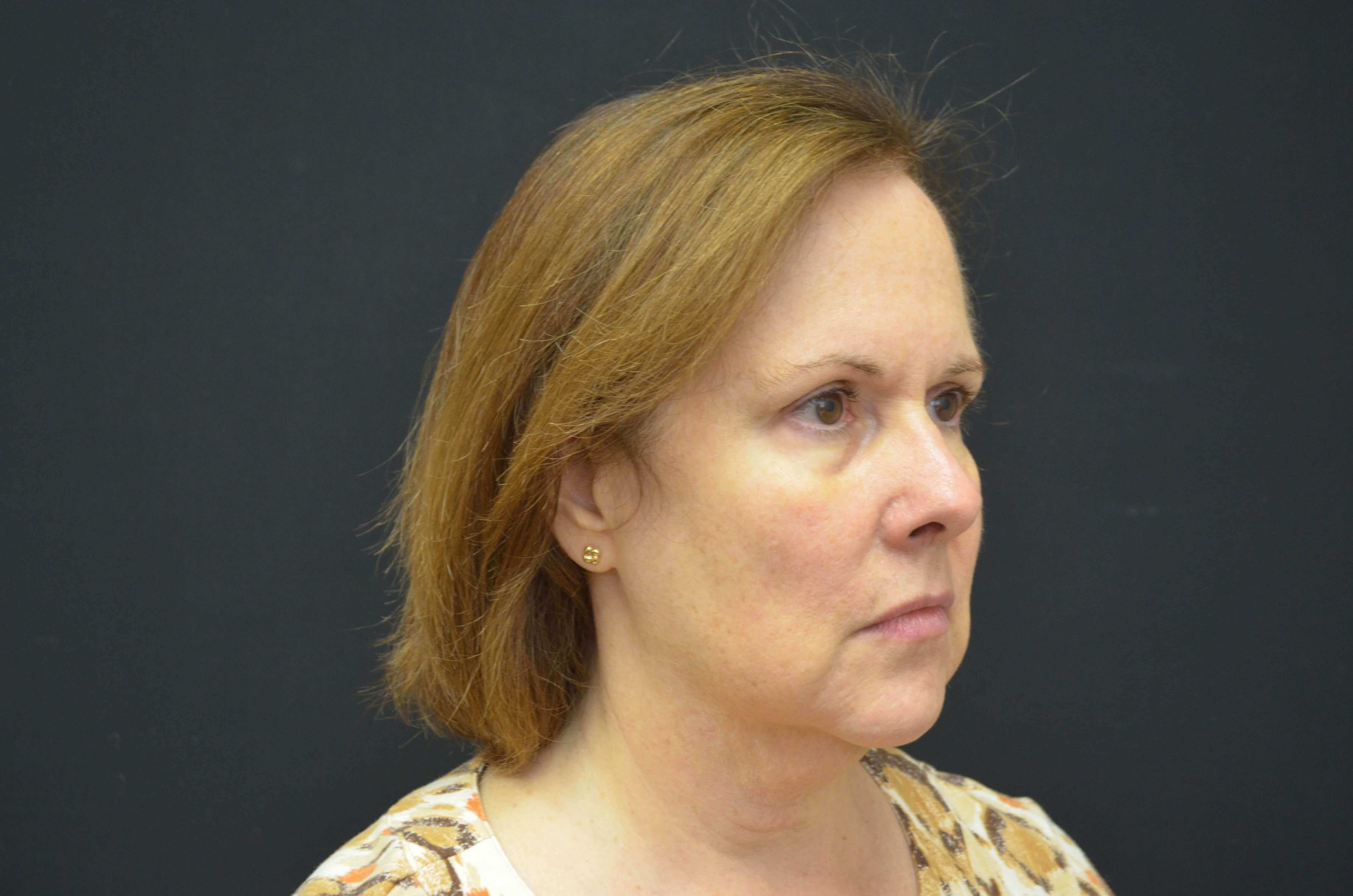 Lower Face Lift- Hinsdale, IL Before