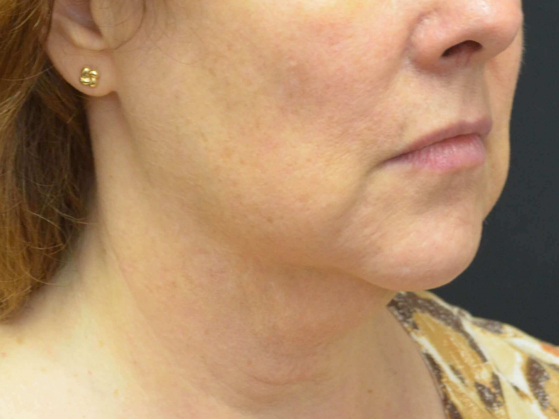 Lower Face Lift- Hinsdale, IL Before