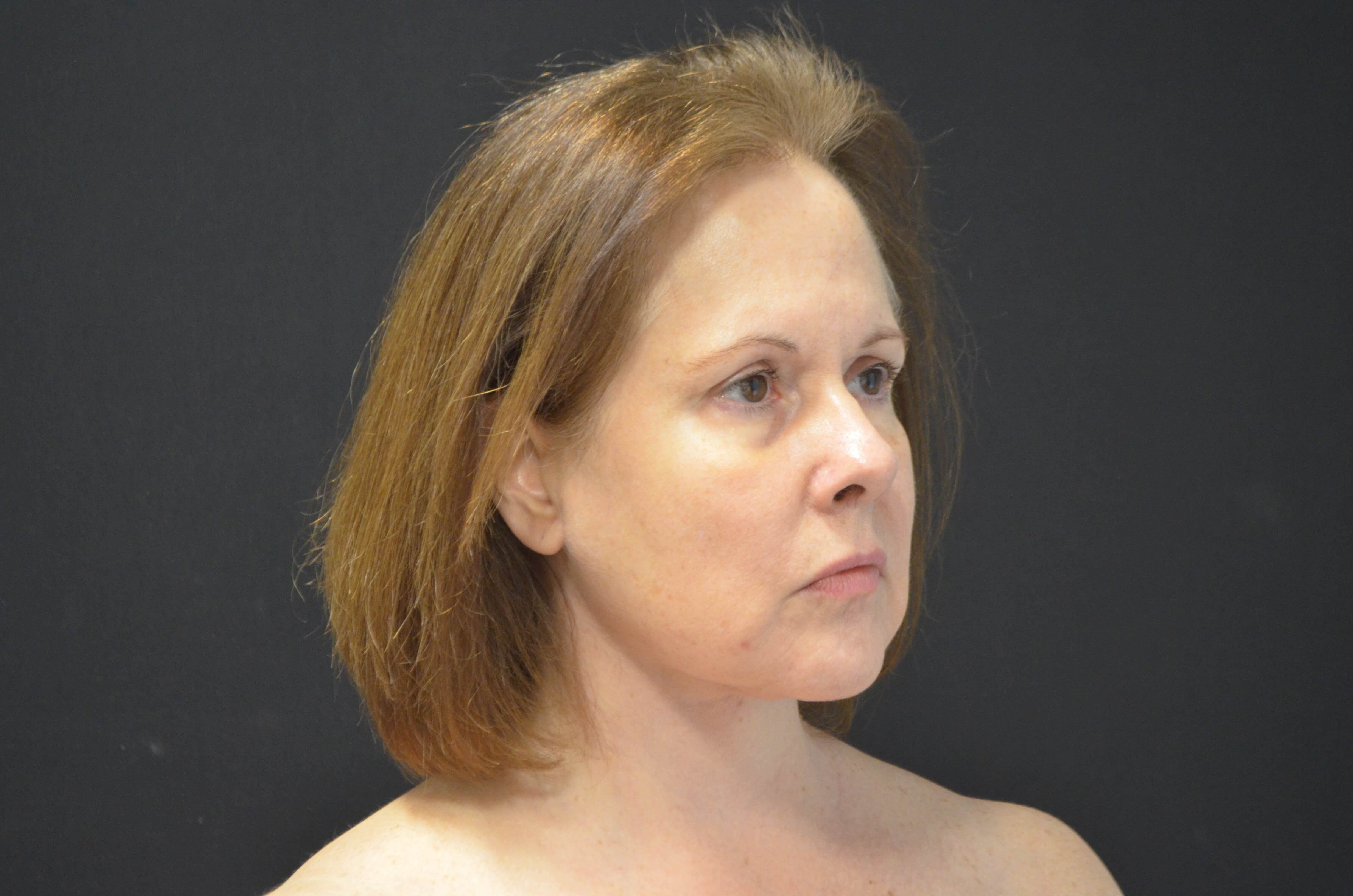 Lower Face Lift- Hinsdale, IL After
