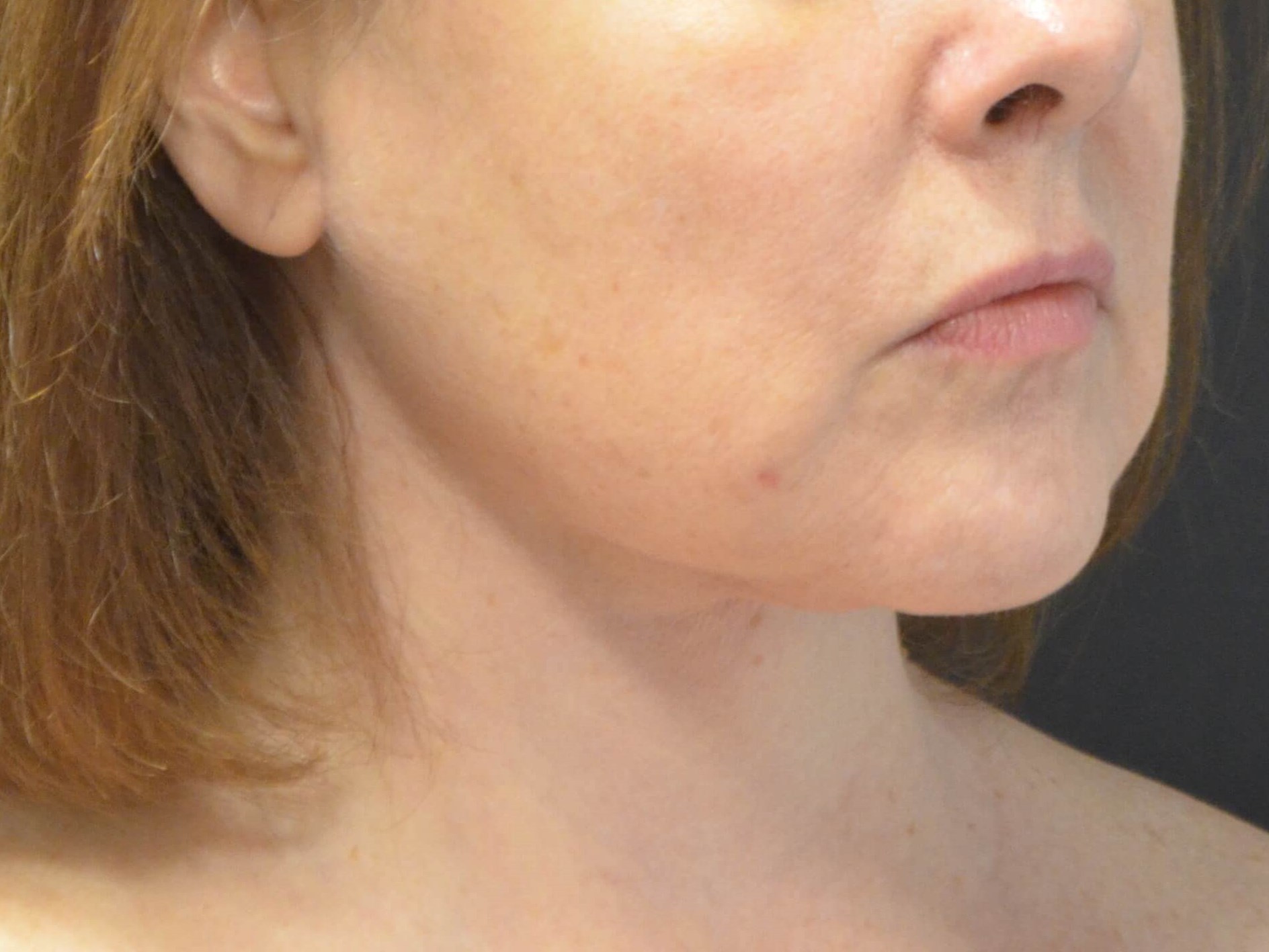 Lower Face Lift- Hinsdale, IL After