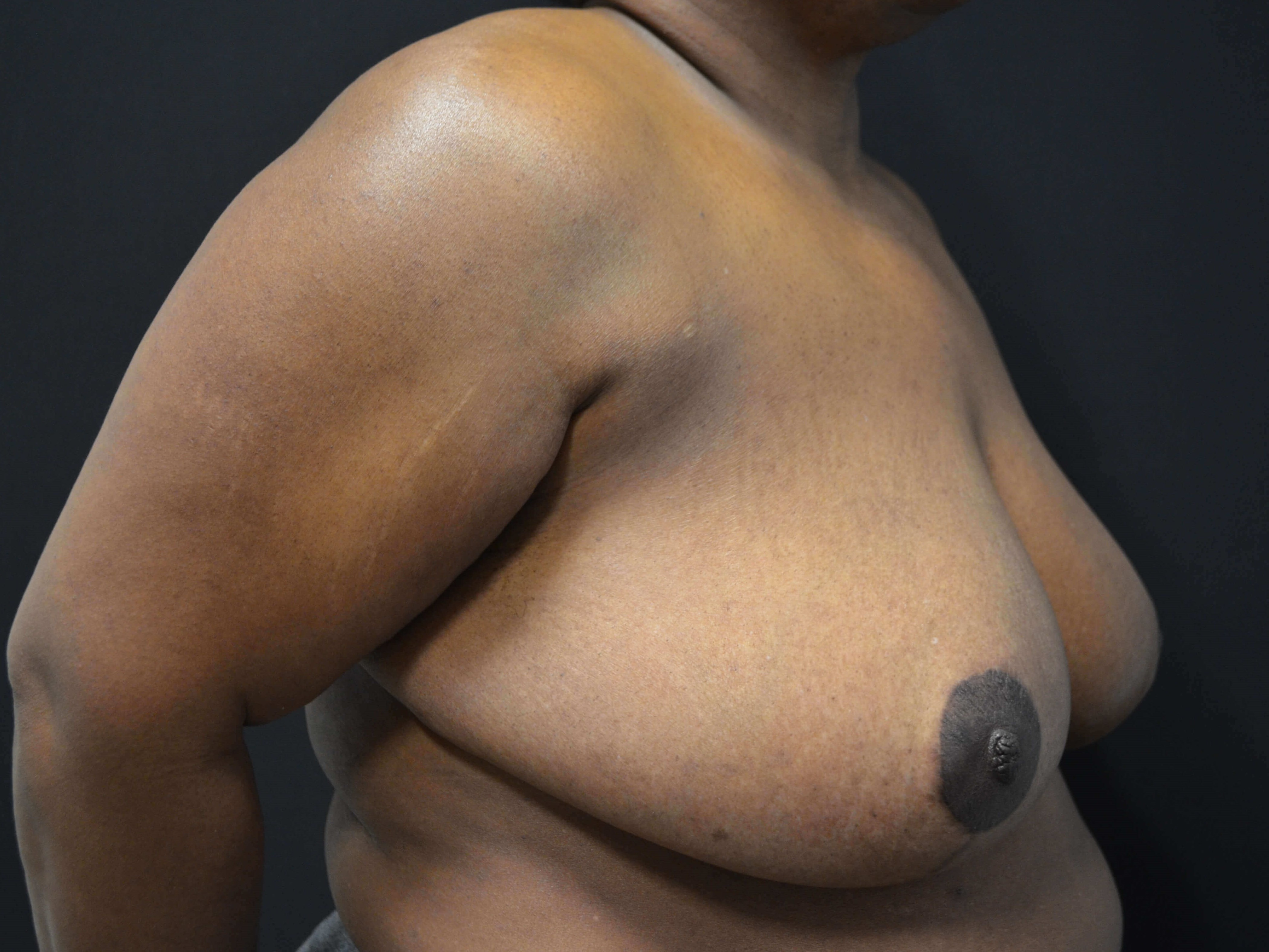 Breast Reduction-Hinsdale, IL After